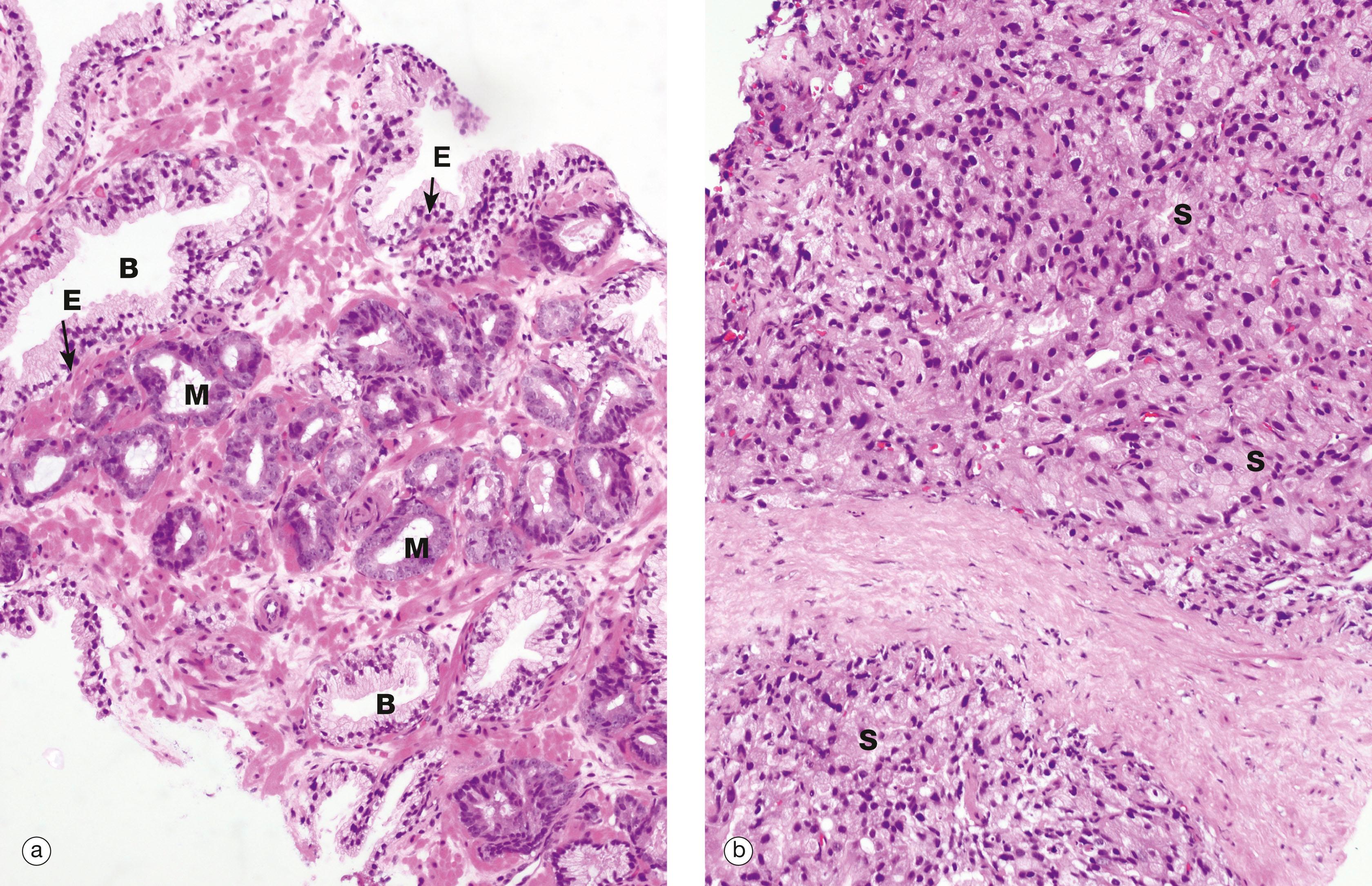 E-Fig. 18.5, Adenocarcinoma of the prostate