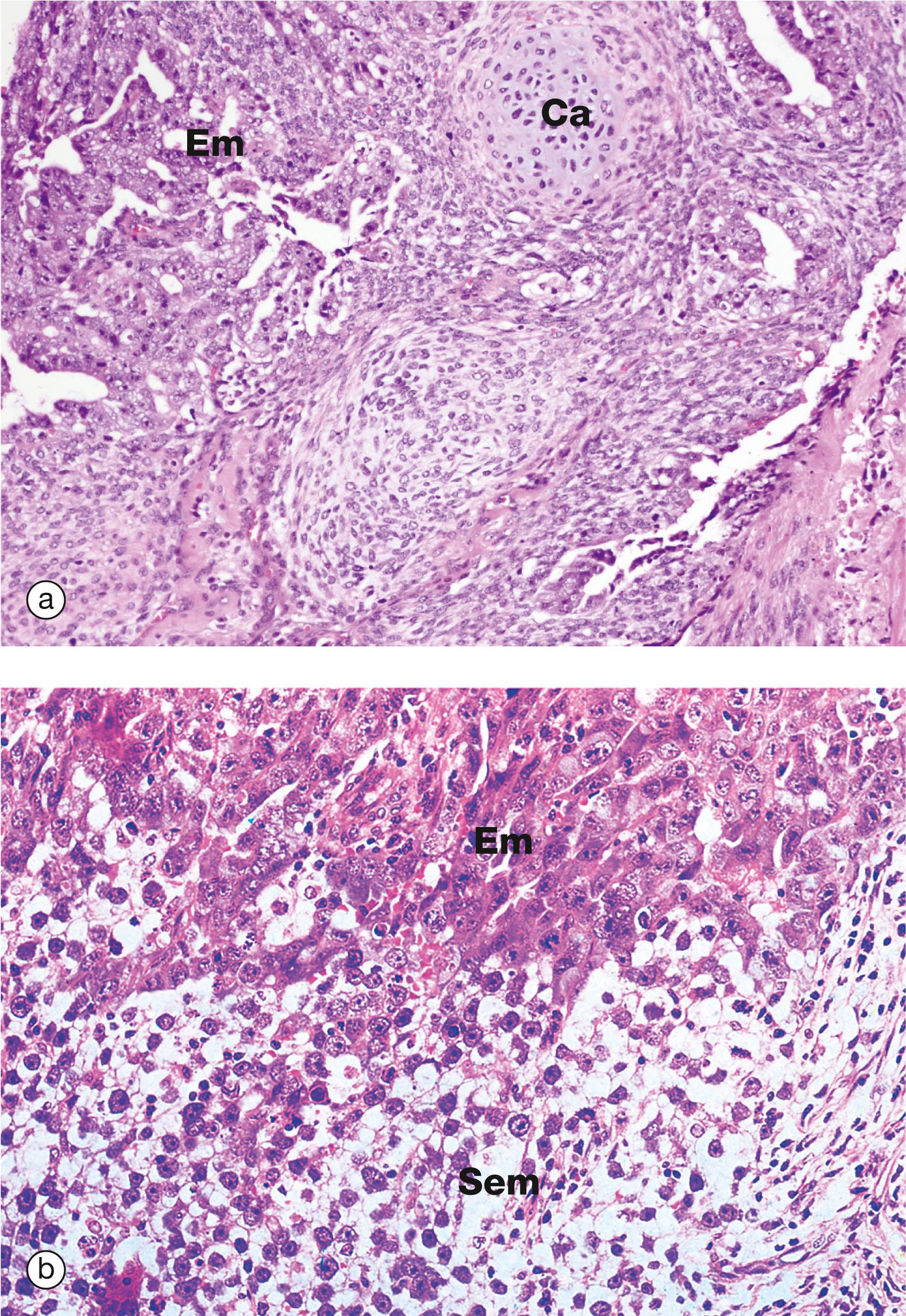 E-Fig. 18.3, Mixed testicular germ cell tumours