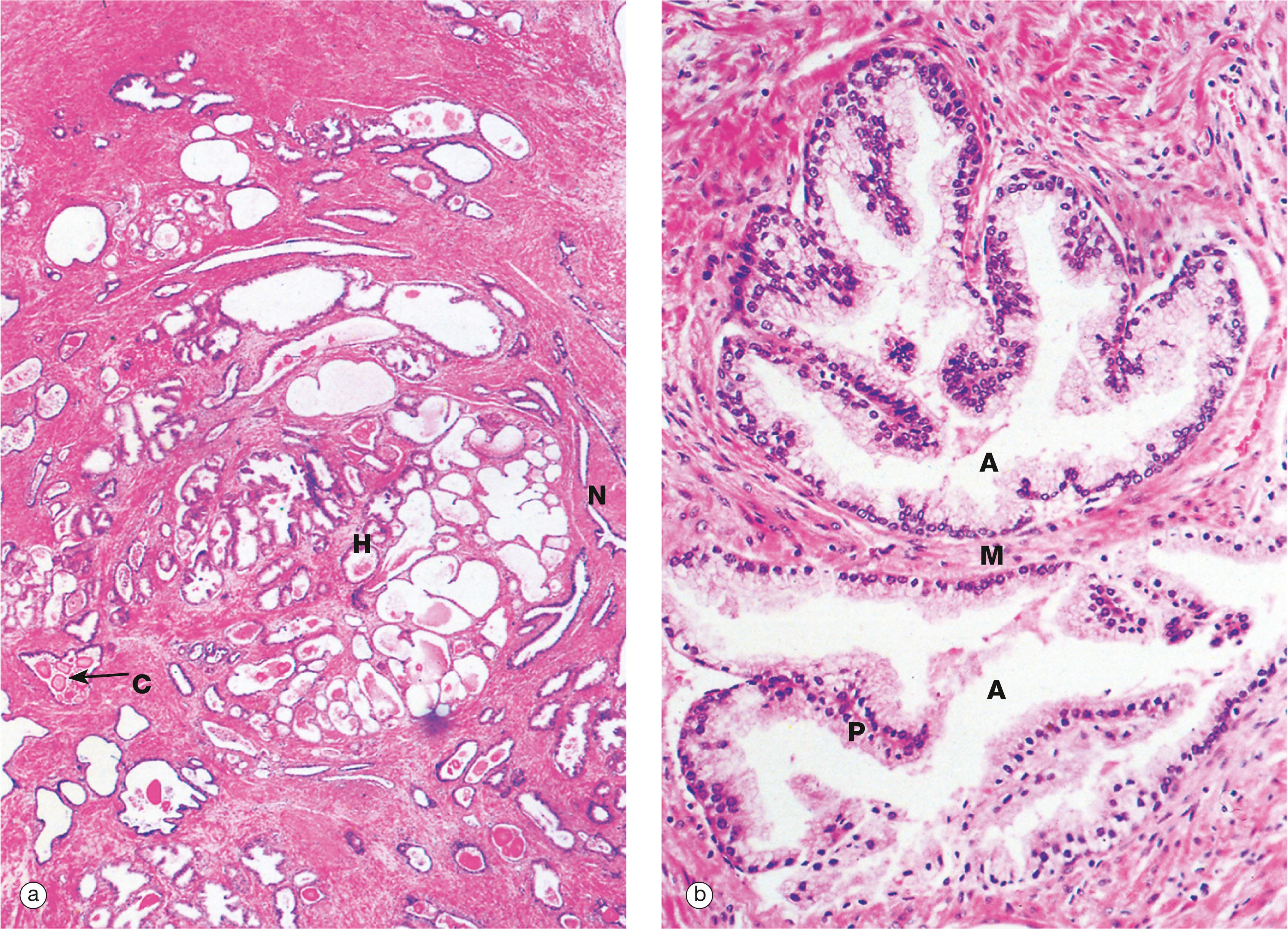 E-Fig. 18.4, Benign prostatic hyperplasia