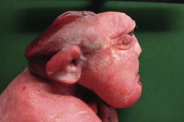 Fig 1, Anencephaly. This side view of a fetus shows an absence of calvaria and only rudimentary nervous tissue.