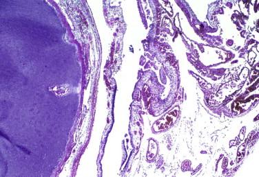 Fig 3, Anencephaly. At low power, this microscopic view shows the area cerebrovasculosa, which consists of poorly formed neuroepithelial and vascular tissue. The immature cartilaginous skull base is shown at left.