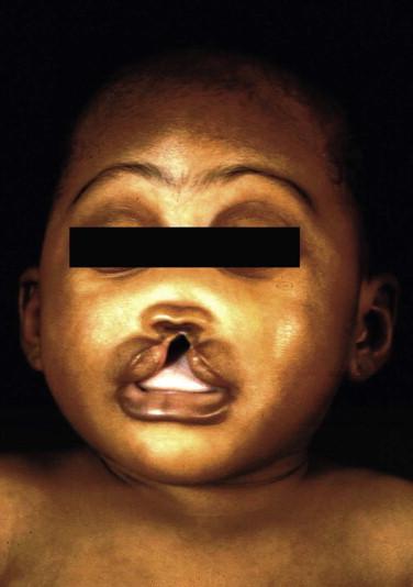 Fig 1, Holoprosencephaly. Characteristic midfacial abnormalities include midline cleft lip and palate, fused nasal structures, hypotelorism, and microcephaly.