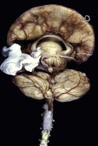 Fig 2, Alobar holoprosencephaly. Only a single cerebral “holospheric” structure is present. The cerebellum, brain stem, and spinal cord are usually normal.