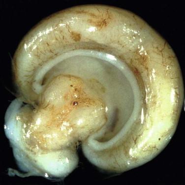 Fig 3, Alobar holoprosencephaly. This image shows absence of separate cerebral hemispheres with fusion of midline nuclei in a fetus.