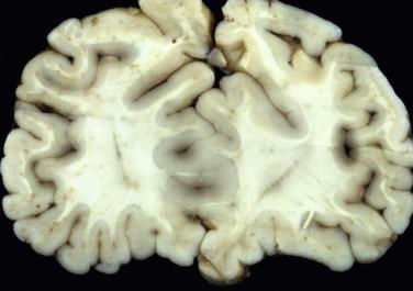 Fig 4, Lobar holoprosencephaly. The rostromedial aspect of the frontal lobes are fused.