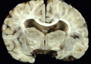 Fig 5, Lobar holoprosencephaly. Two distinct cerebral hemispheres have formed, but there is fusion of inferior-medial structures including the thalamus and mammillary bodies. There is no septum pellucidum.