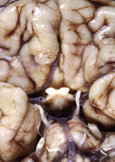 Fig 6, Arrhinencephaly. An inferior view of the orbital frontal region demonstrates the absence of olfactory bulbs and tracts with the associated absence of the straight sulci (gyri recti).