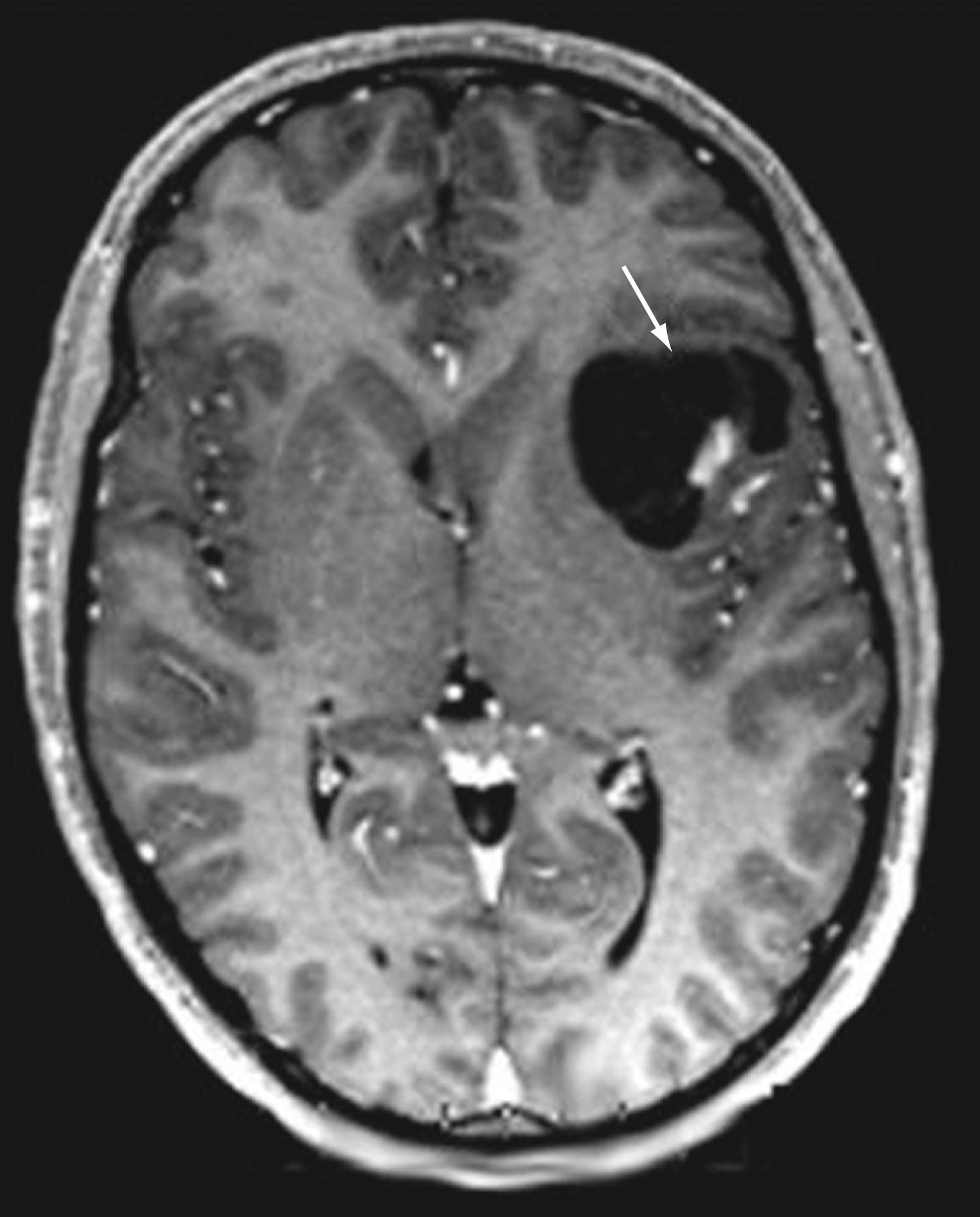 Figure 79.2, MR image depicting a left frontal ganglioglioma (arrow).