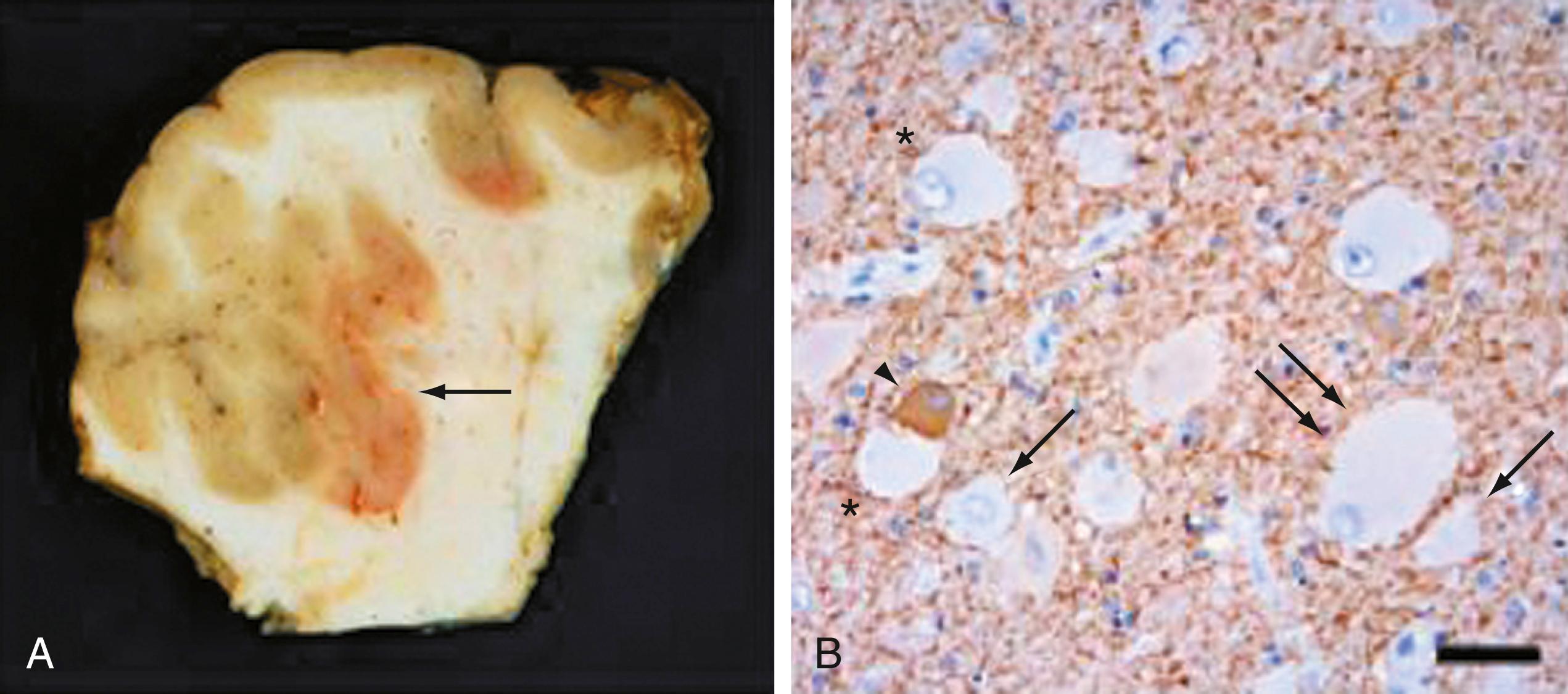 Figure 79.3, Histopathology of Palmini type II cortical dysplasia.