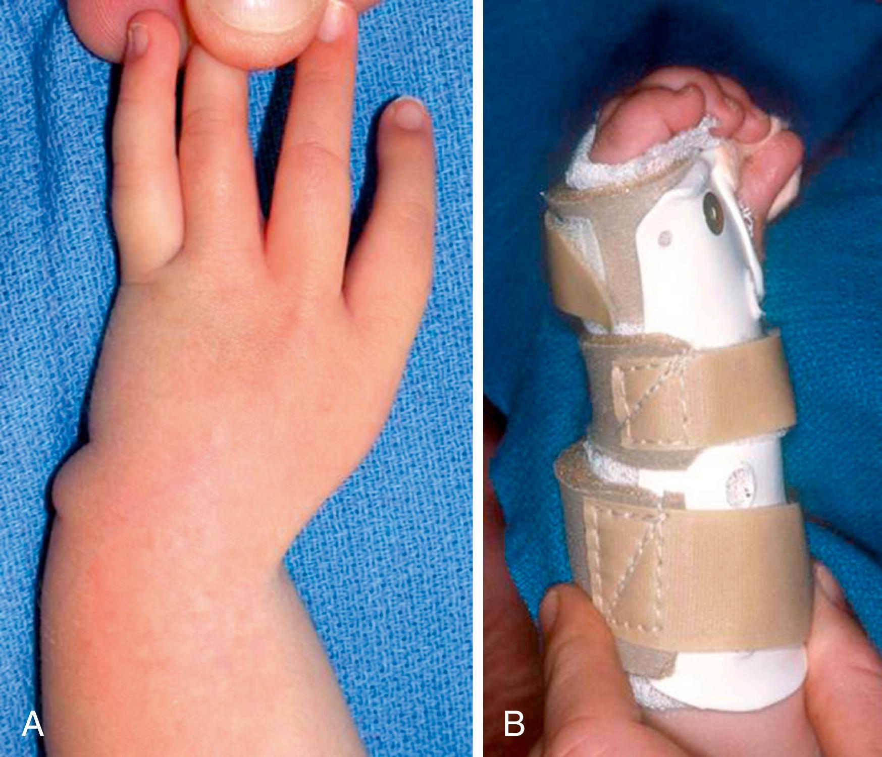 eFig. 38.1, (A) Stretching and (B) splinting for left type 4 radial deficiency at 1½ years old.