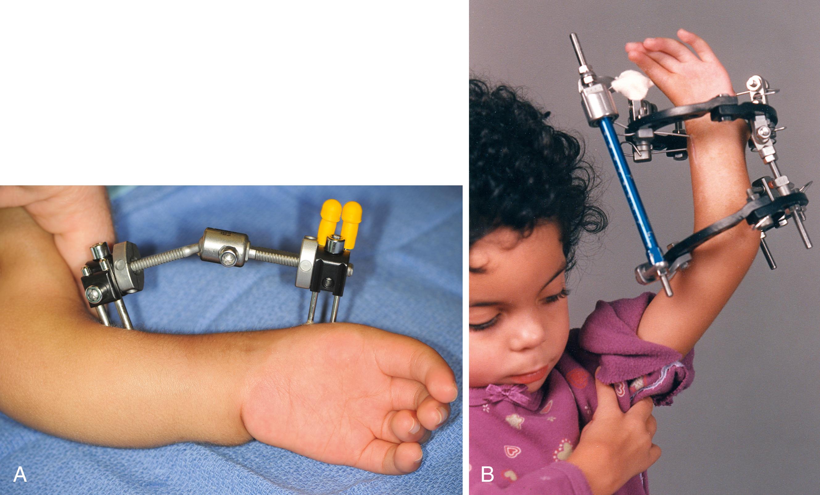 Fig. 38.4, Radial deficiency with rigid deformity is often treated with preliminary soft tissue distraction. A, Uniplanar device along the radial side of the forearm. B, Multiplanar device for additional control of hand and forearm.