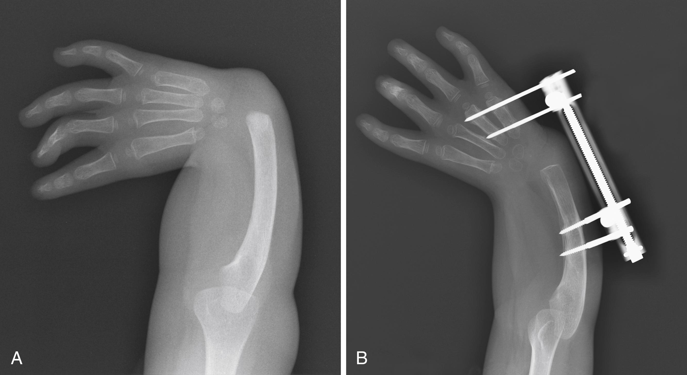 Fig. 38.5, A 3-year-old with bilateral radial deficiency. A, Preoperative x-ray of right forearm and hand. B, X-ray after distraction to lengthen soft tissues and ease centralization.