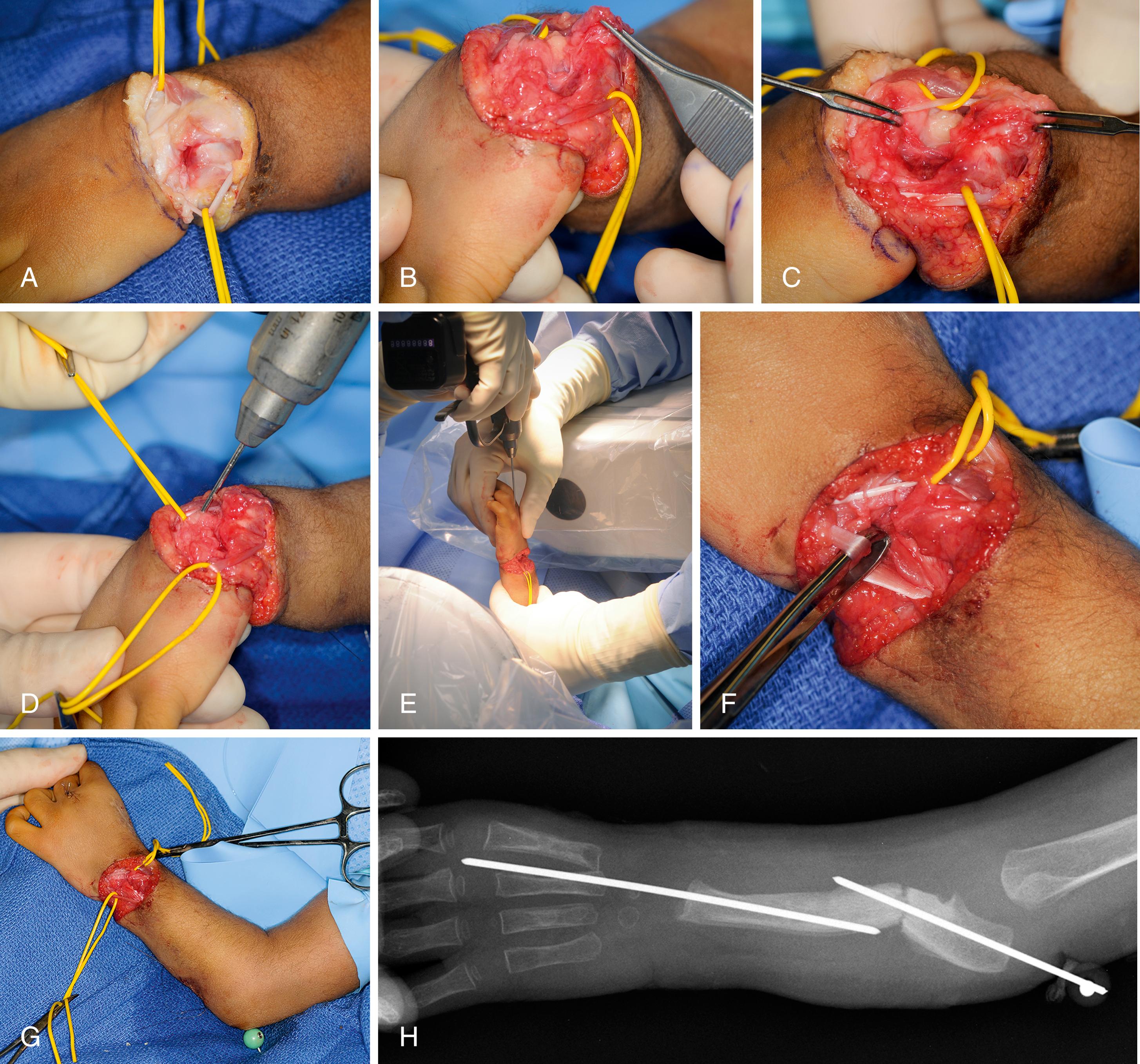 Fig. 38.6, A 1½-year-old male with isolated left type 4 radial deficiency and absent thumb treated with preliminary distraction and centralization. A, Following fixator removal, an elliptical dermodesis incision is made and the underlying tendons are identified. B, Ulnocarpal capsulotomy. C, Ulnar head isolated. D, Antegrade 0.062-inch Kirschner wire. E, Kirschner wire passed retrograde across ulnocarpal joint. F, Extensor carpi ulnaris imbrication. G, Concomitant ulnar osteotomy and overall alignment. H, Postoperative x-ray with Kirschner wires across ulnocarpal joint and ulnar osteotomy.