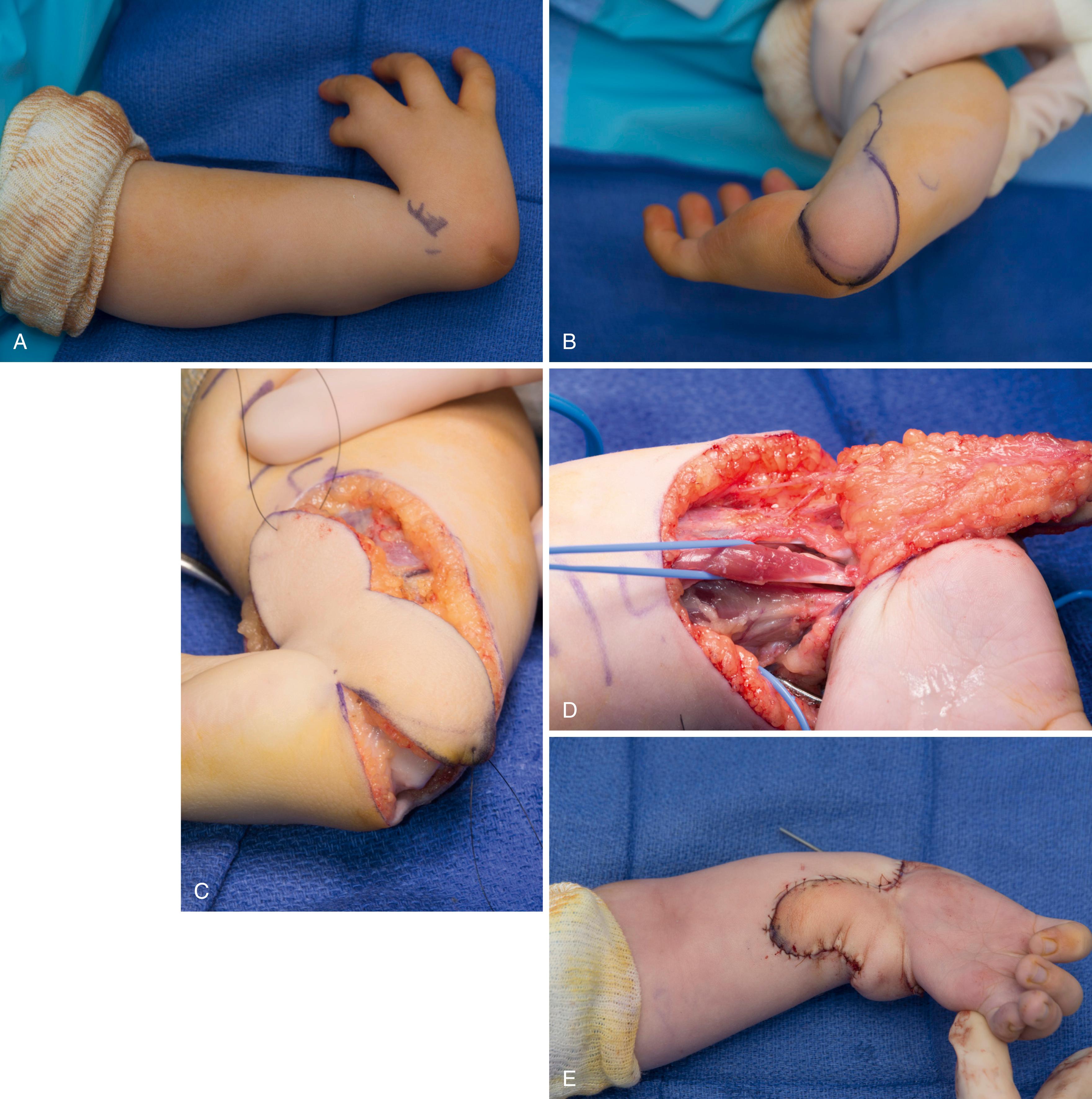 Fig. 38.7, Intraoperative photos of a volar bilobed flap and soft tissue rebalancing for severe radius deficiency. A, Preoperative photo demonstrating significant radial deviation. B, Volar/ulnar view of the wrist with bilobed flap incision marked. C, The flap has been raised. D, The volar flap allows for wide exposure to perform tendon releases and/or transfers as needed. E, Postoperative appearance. A Steinman pin is placed to allow soft tissue rest and prevent flap necrosis.