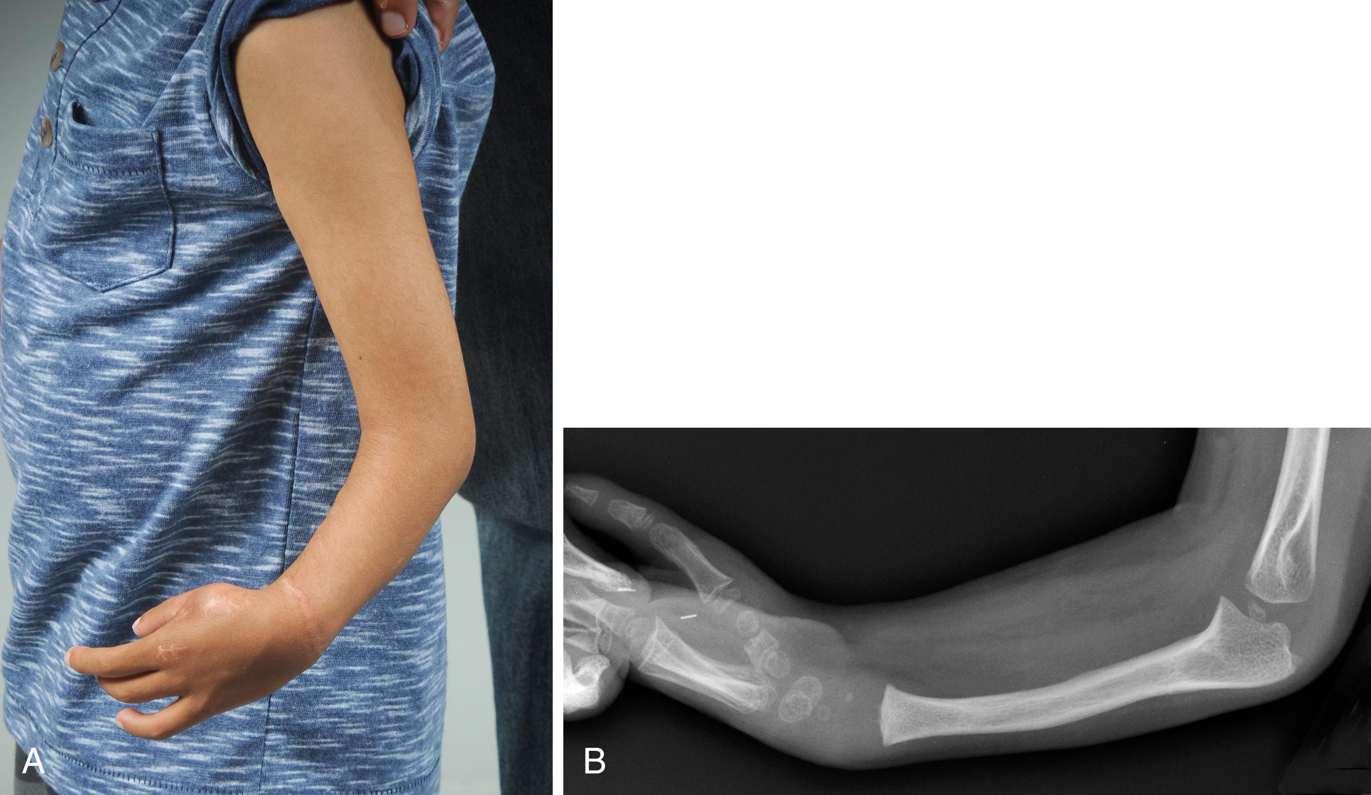 Fig. 38.9, A 3½-year-old child is shown 2 years following the centralization detailed in Fig. 38.6 . A, Clinical appearance with mild recurrence. B, X-ray with hypertrophy of ulna.