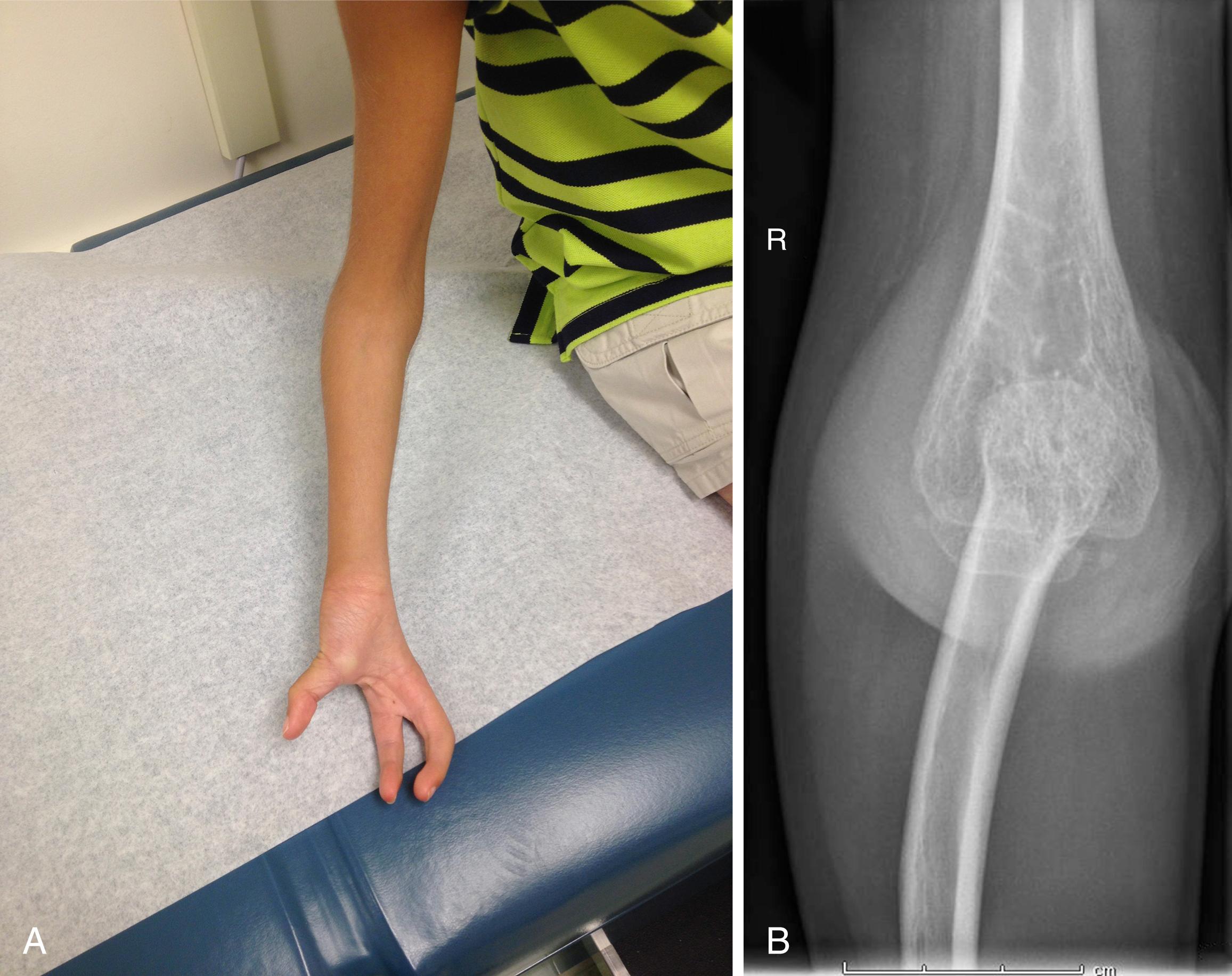 Fig. 38.10, Clinical photograph (A) and anteroposterior radiograph (B) of a child’s arm with right ulnar longitudinal deficiency.