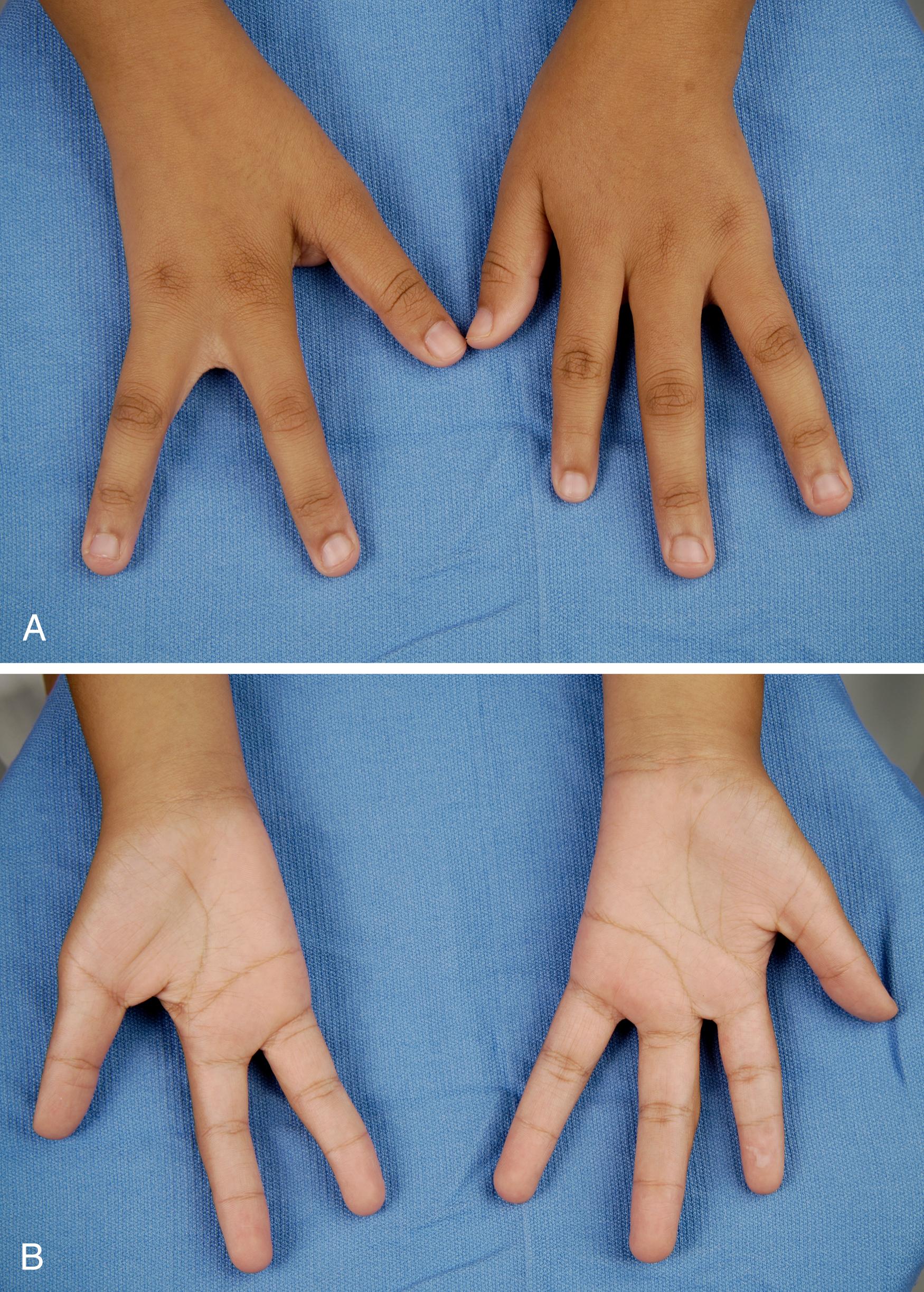 Fig. 38.11, A 9-year-old with ulnar deficiency isolated to her hands. A, Dorsal view with three digits on the right hand and four digits on the left hand. B, Palmar view.