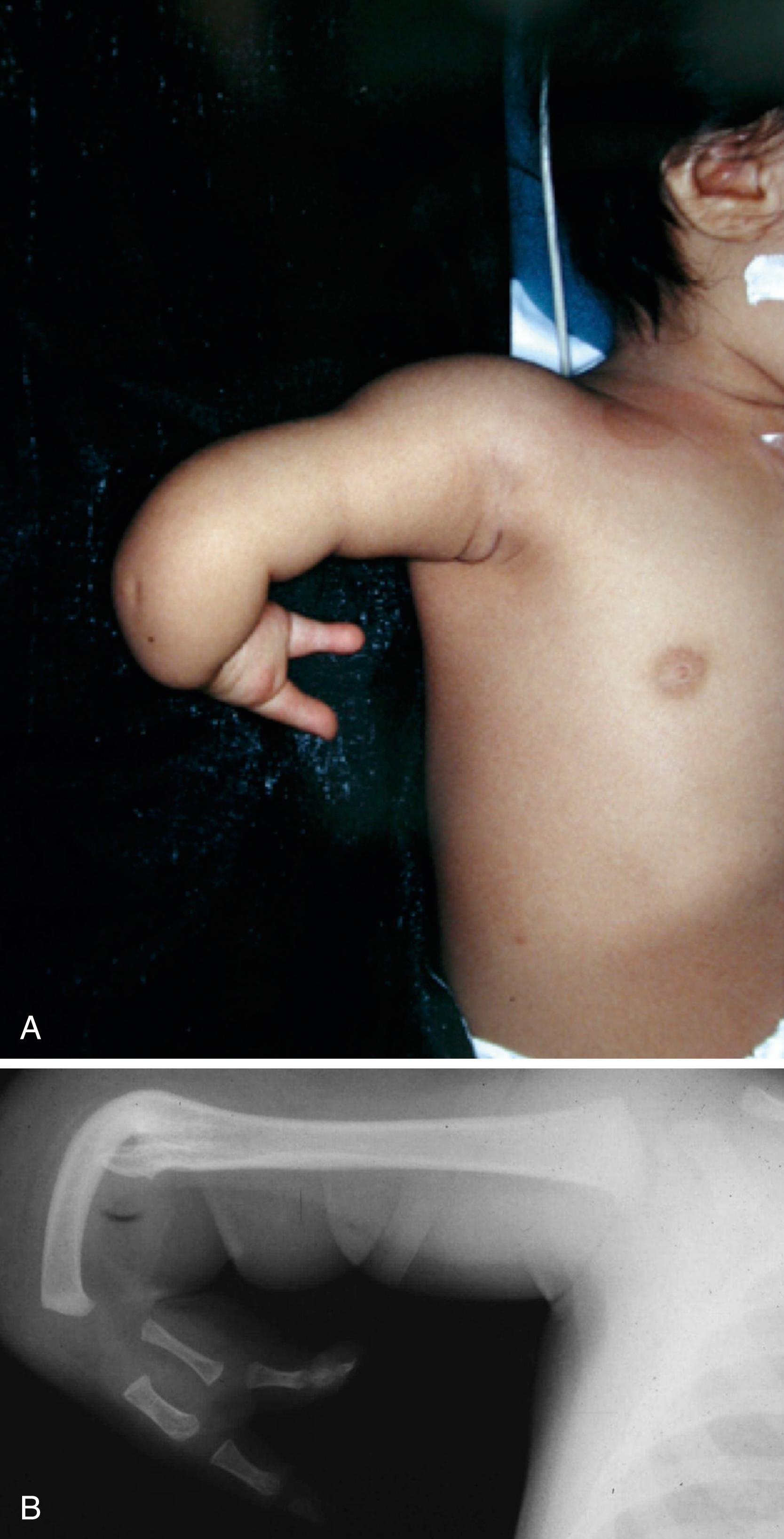 Fig. 38.12, A, Clinical photograph. B, Radiograph demonstrating typical appearance of the limb with ulnar longitudinal deficiency.