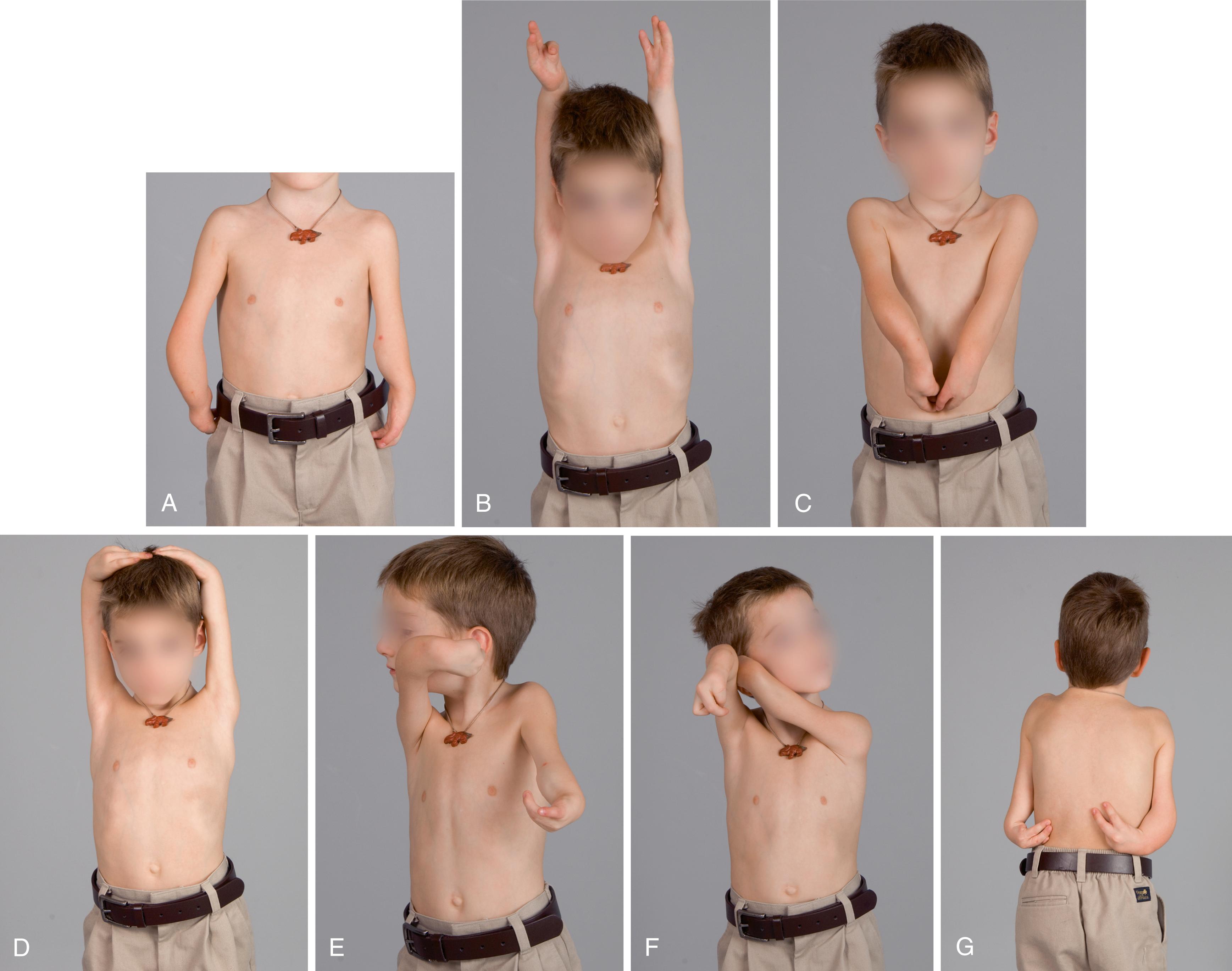 Fig. 38.13, A 6-year-old with untreated bilateral ulnar deficiency. A, Resting posture with the left hand facing backward. B, Overhead reach. C, Midline activity. D, Touching the top of the head for washing hair. E, Touching the left ear with the right hand. F, Touching the left ear with the right hand by using the left arm as an assist. G, Reaching back with both hands.