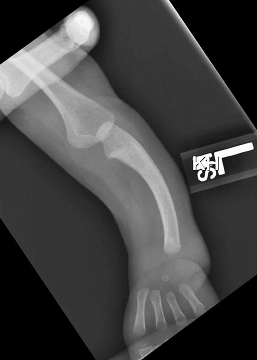 eFig. 38.2, Radiograph of left type 4 radial deficiency.
