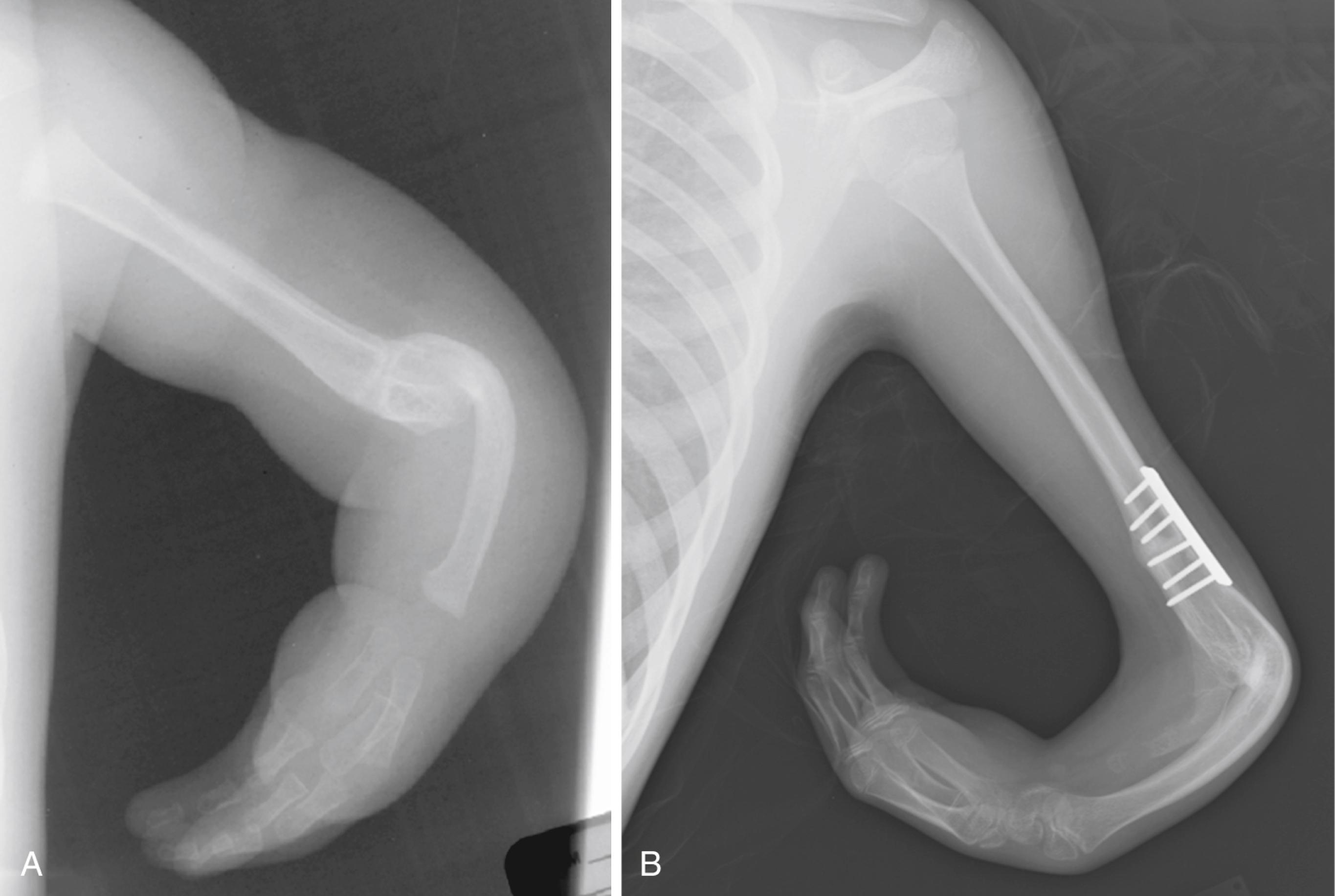 Fig. 38.14, Preoperative (A) and postoperative (B) radiographs demonstrating humeral osteotomy in a patient with ulnar deficiency, to correct hand-on-flank deformity.