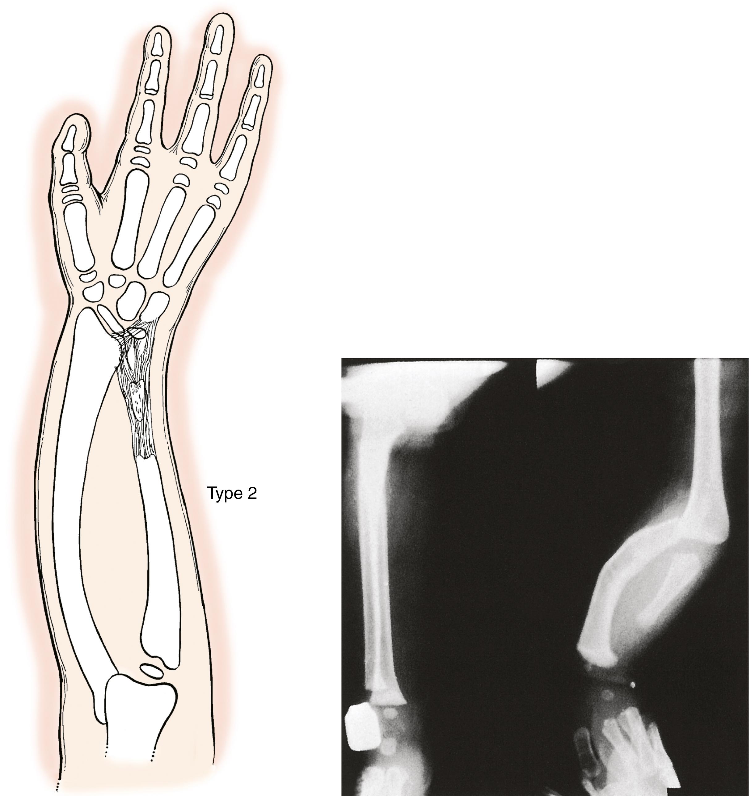 Fig. 38.15, An ulnar anlage acts as a tethering force on the distal radius and wrist.