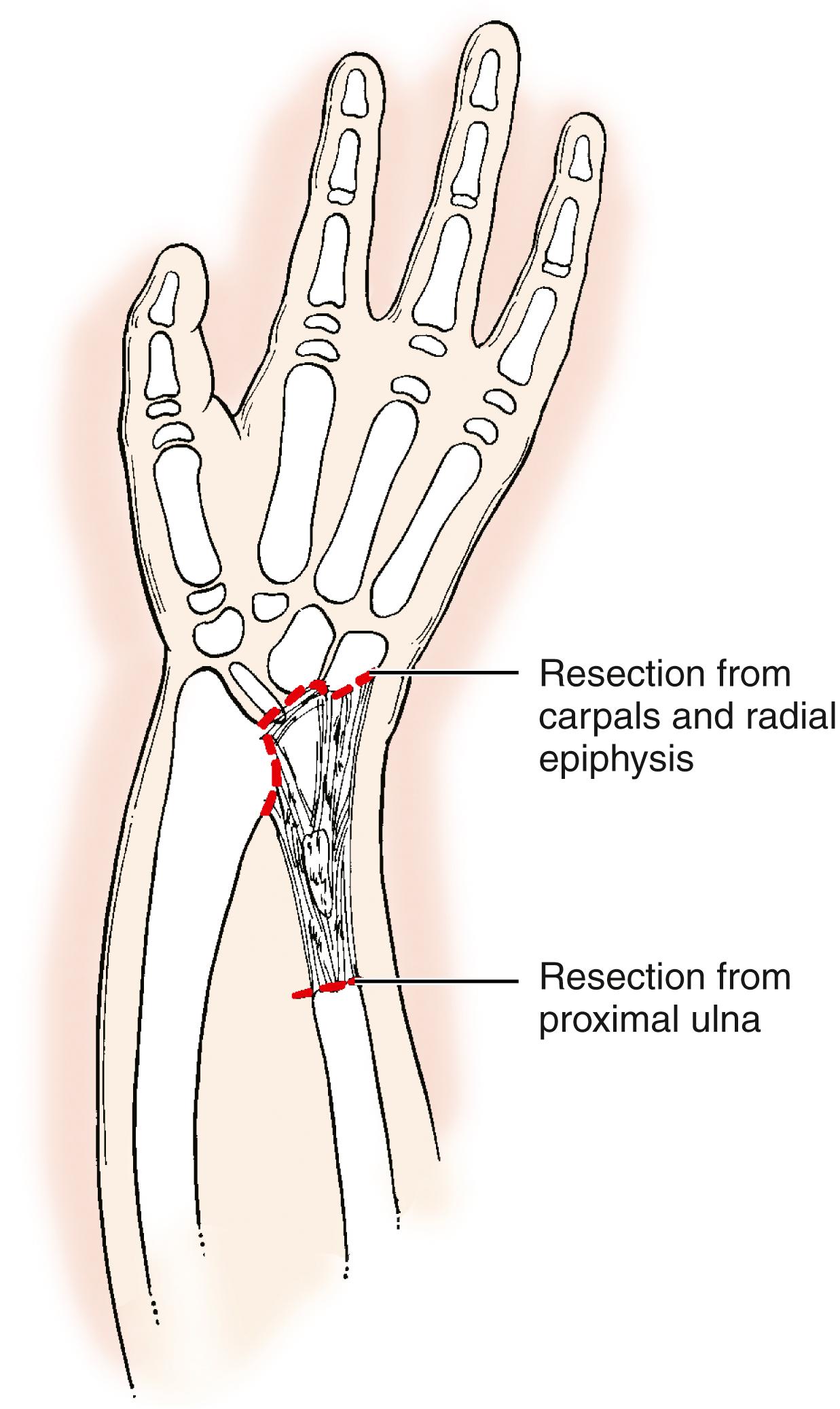 Fig. 38.16, Excision of the ulnar anlage. This may prevent further ulnar deviation of the hand.