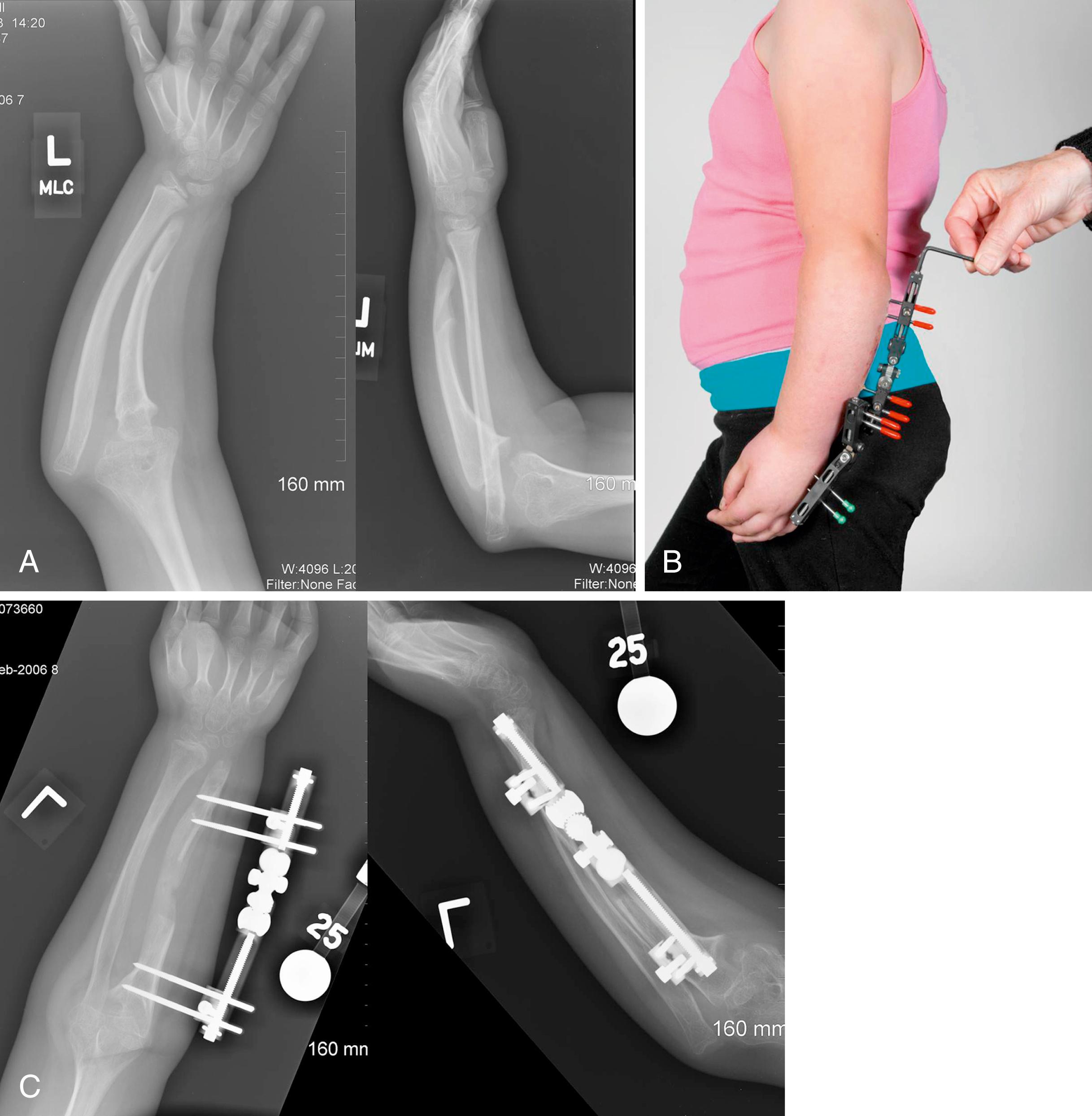 Fig. 38.18, Ulnar lengthening for ulnar deficiency. A, Preoperative radiographs demonstrating significant dislocation of the radial head. B, Uniplanar external fixator in place. C, Postoperative radiographs demonstrating bone regeneration through the osteotomy site, with improved position of the radial head. Complete reduction of the radial head was not attempted given the long-standing nature of the deformity.