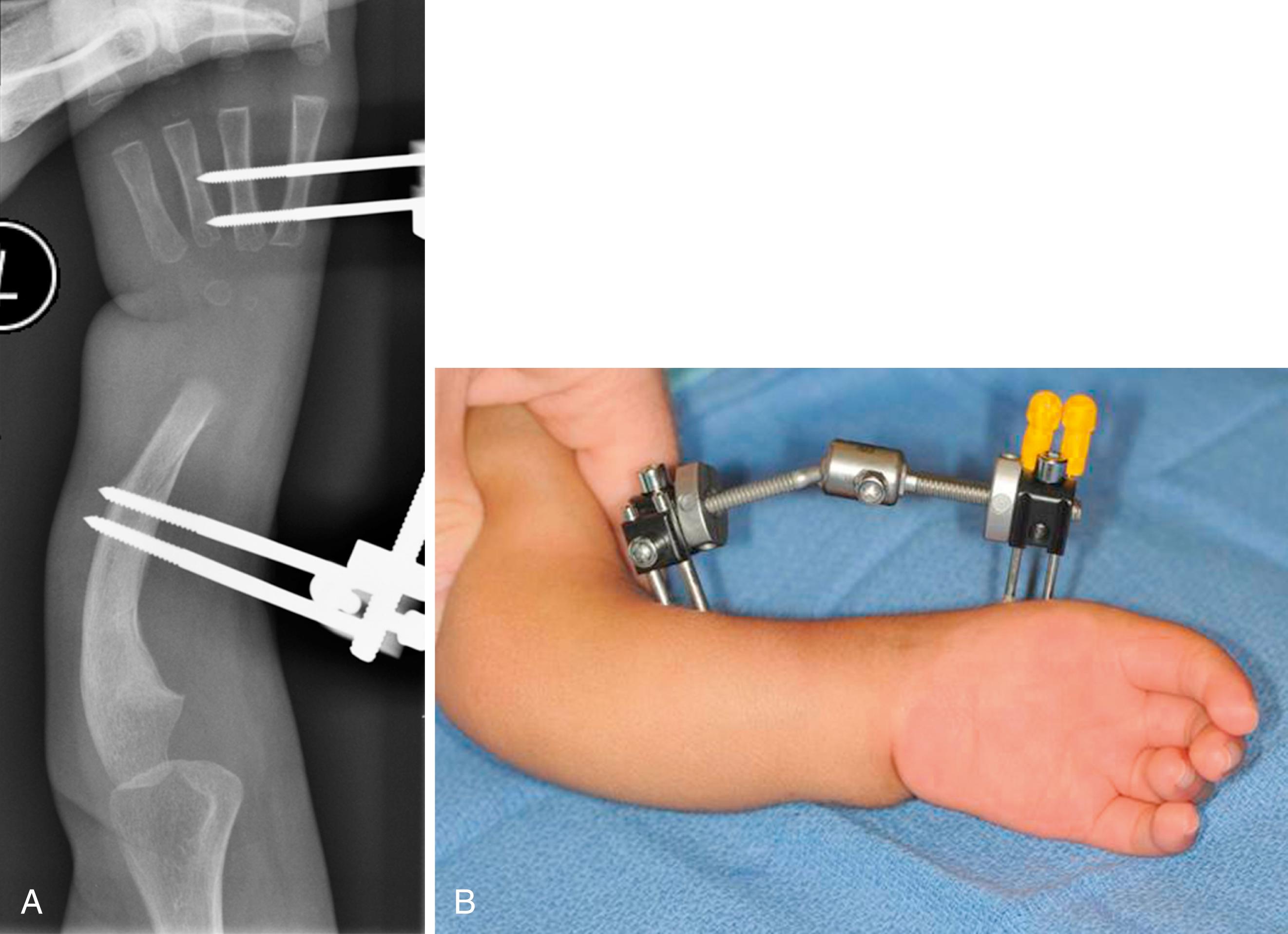 eFig. 38.3, (A) Radiograph and (B) clinical photograph of preliminary distraction.