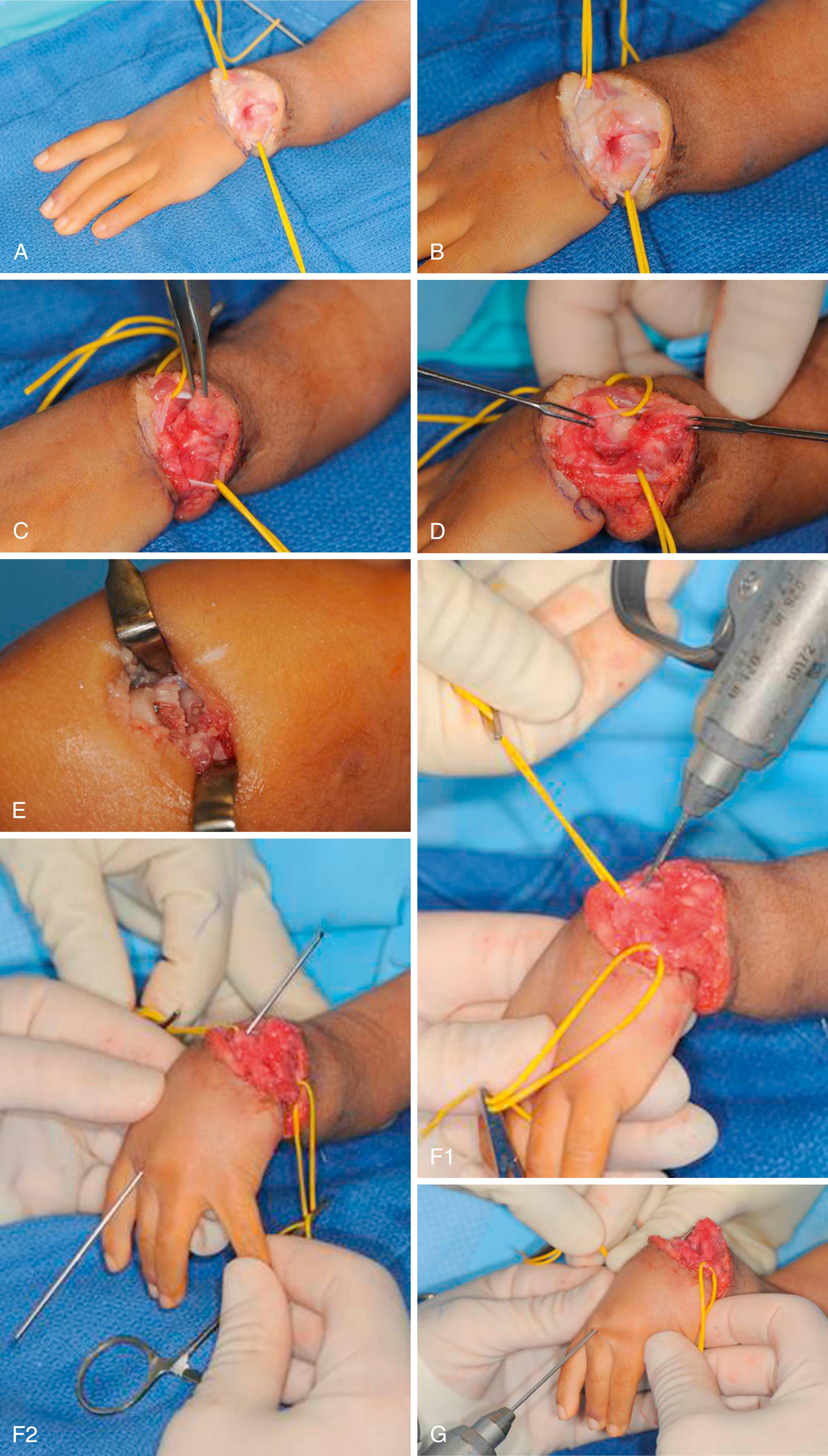 eFig. 38.4, Centralization. A, Elliptical dermodesis incision. B, Isolate tendons. C, Open capsule. D, Identify ulnar head. E, Perform ulnar osteotomy. F, Antegrade 0.062-inch wire. G, Kirschner wire joystick. H, Retrograde Kirschner wire. I, Pinning carpus and ulnar osteotomy. J, Capsular repair, centralize tendons. K, Extensor carpi ulnaris imbrication.