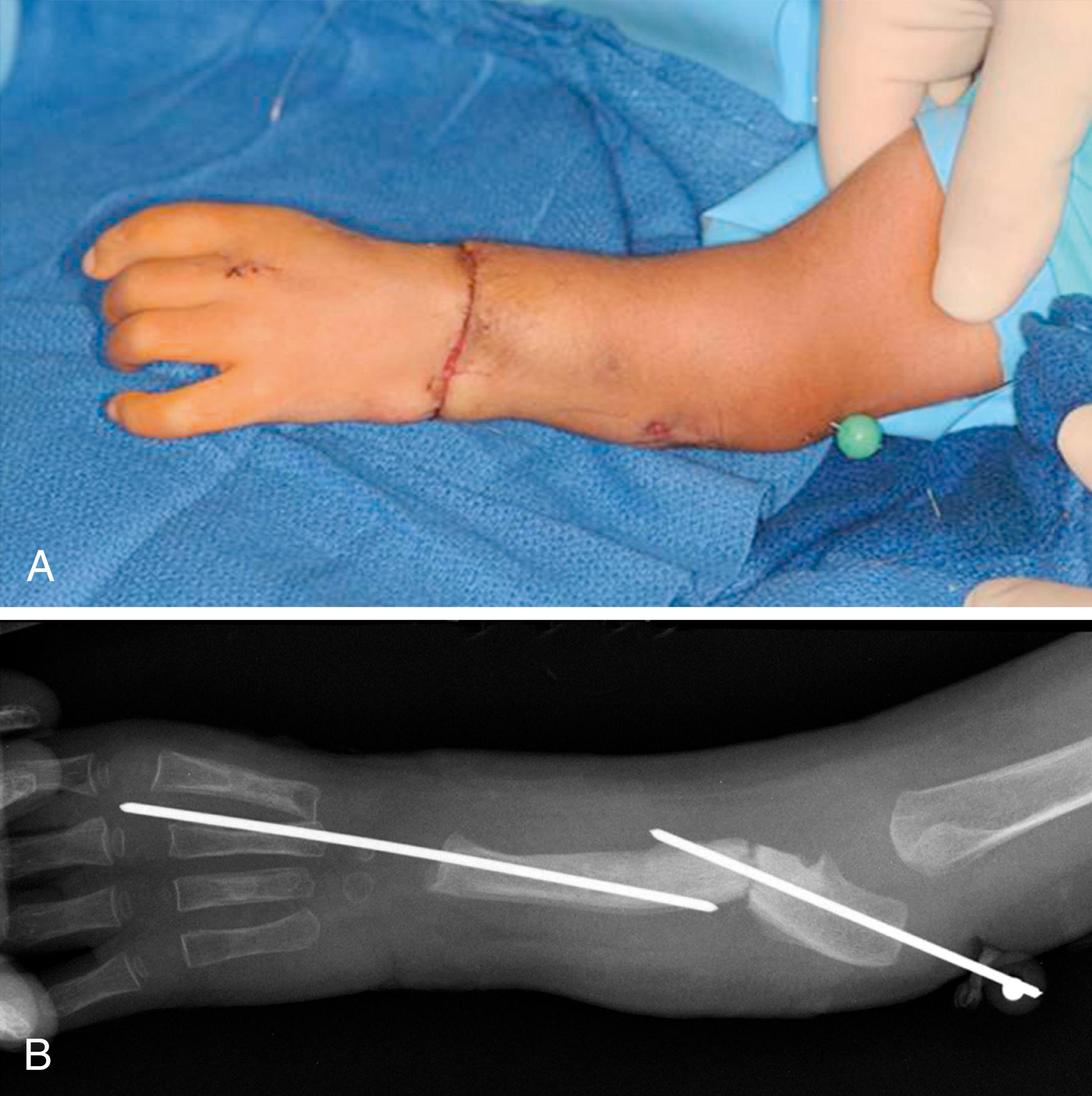 eFig. 38.5, (A) Clinical photograph and (B) radiograph of the final result.