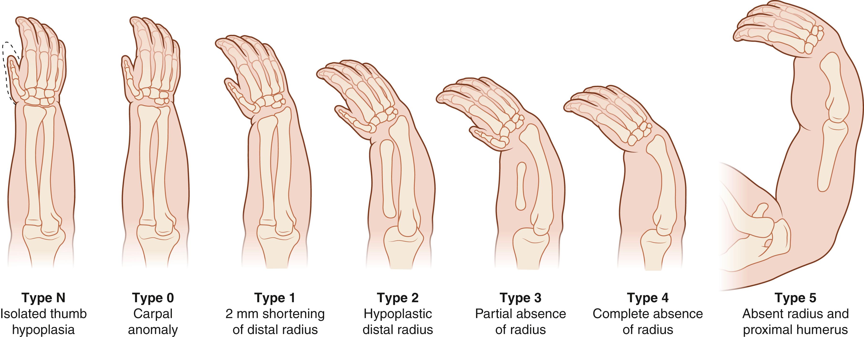 Fig. 38.1, Types of radial deficiency.