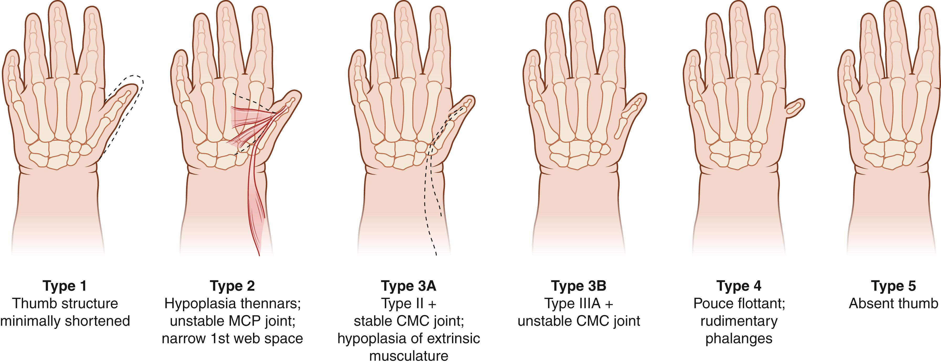 Fig. 38.2, Modified Blauth classification of thumb deficiency.