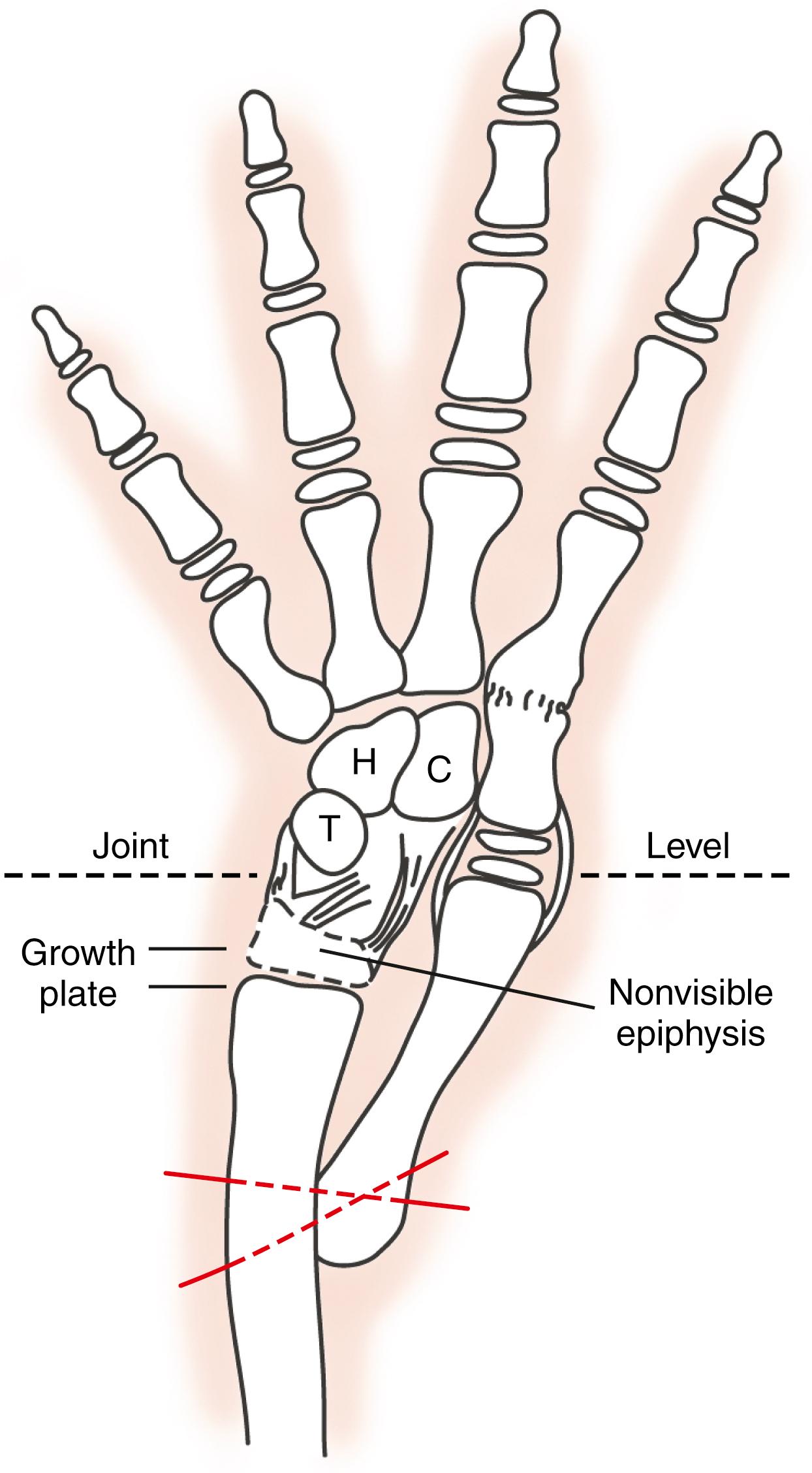 Fig. 38.3, Diagram of free toe transfer to support the radial side of the wrist. The proximal phalanx of the toe is fused to the base of the second metacarpal, and the proximal metatarsal is affixed to the side of the distal ulna. C, Capitate; H, hamate; T, triquetrum.