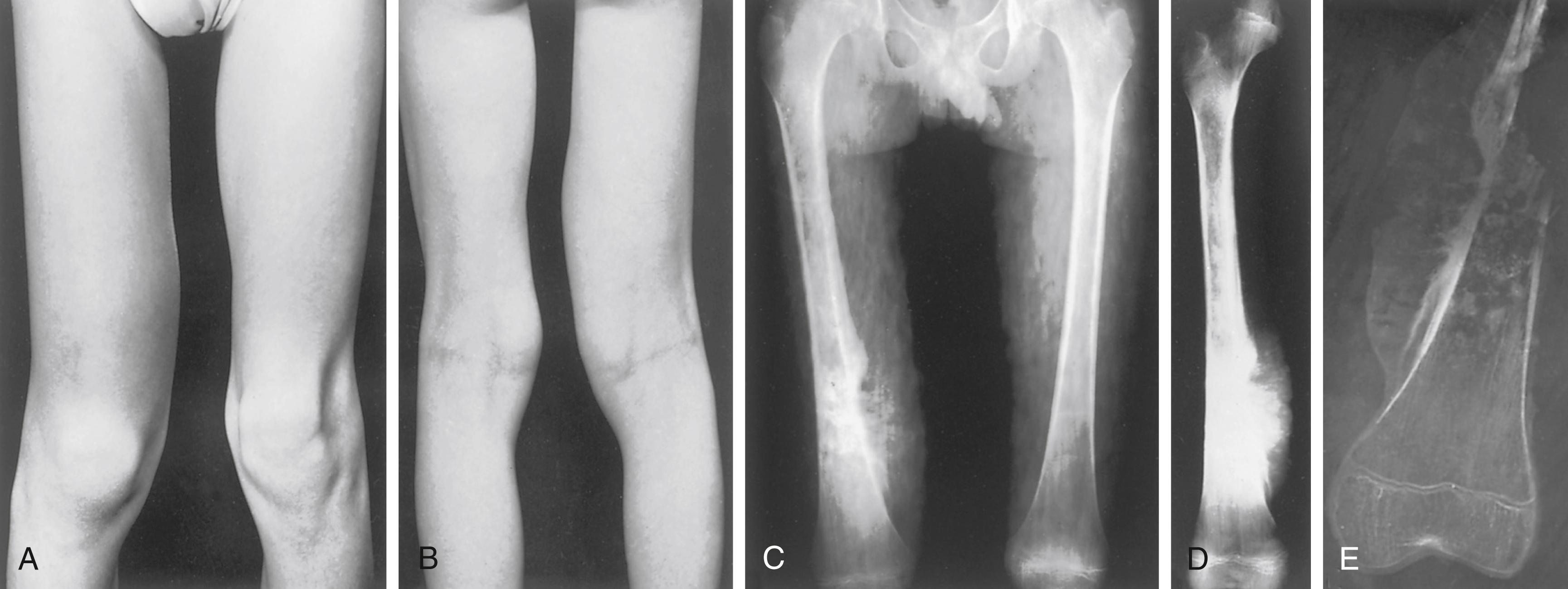 FIG. 26.3, Osteosarcoma of the right distal femur. (A and B) Clinical appearance, showing swelling of the right lower thigh. (C and D) Radiographs of the femora. Note the sunburst appearance and areas of increased radiopacity (neoplastic bone) and radiolucency (bone destruction). (E) Radiograph of a gross specimen, sectional slab.