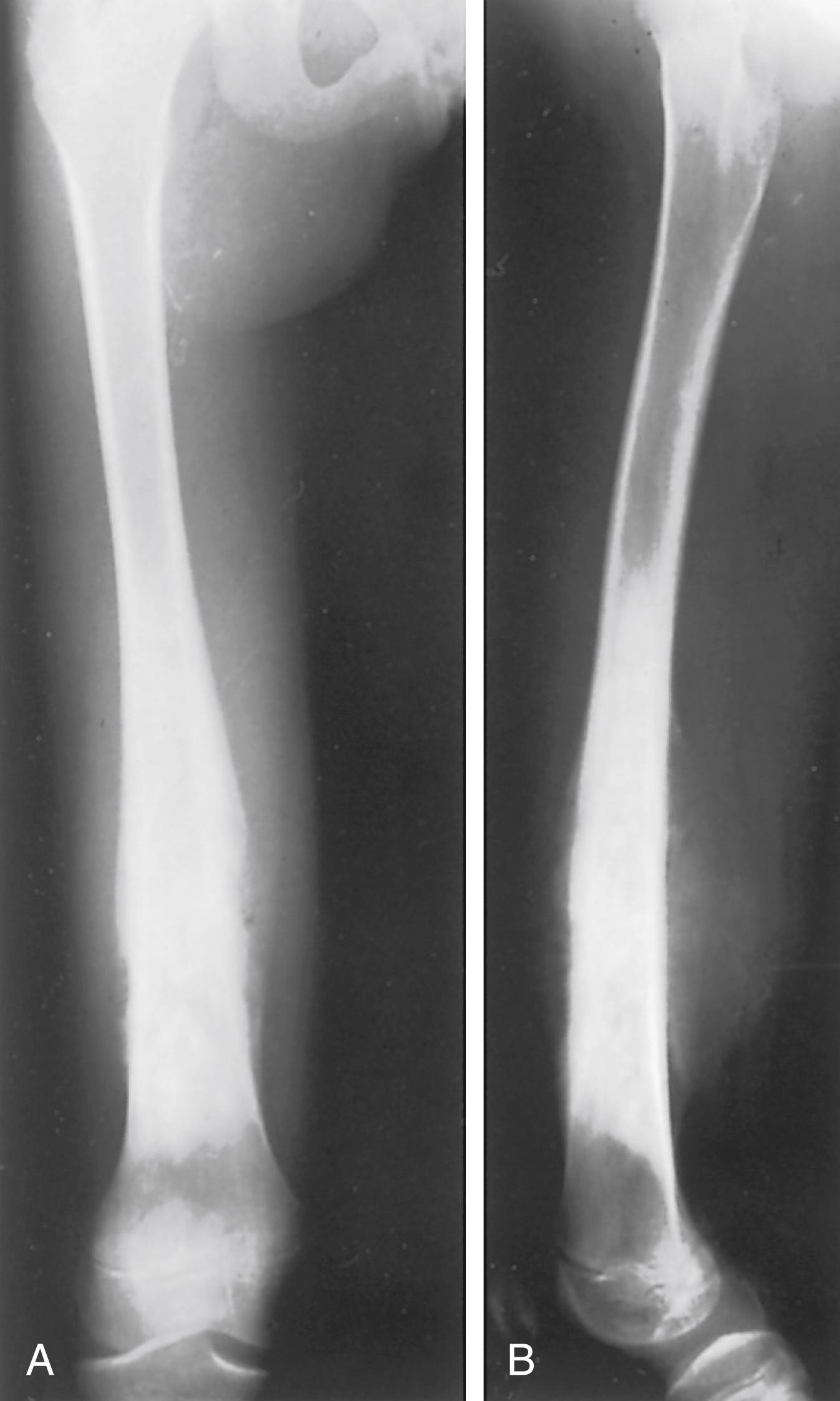 FIG. 26.4, Osteosarcoma of the distal femur in a 12-year-old girl. (A and B) Radiographs of the femur. The normal trabecular pattern is lost as the neoplastic bone invades the cortex and raises the periosteum. Note the sunburst appearance and Codman’s triangle. The conical plug of the tumor in the midshaft (best seen on the lateral view) marks the proximal limit of the lesion lengthwise along the shaft.