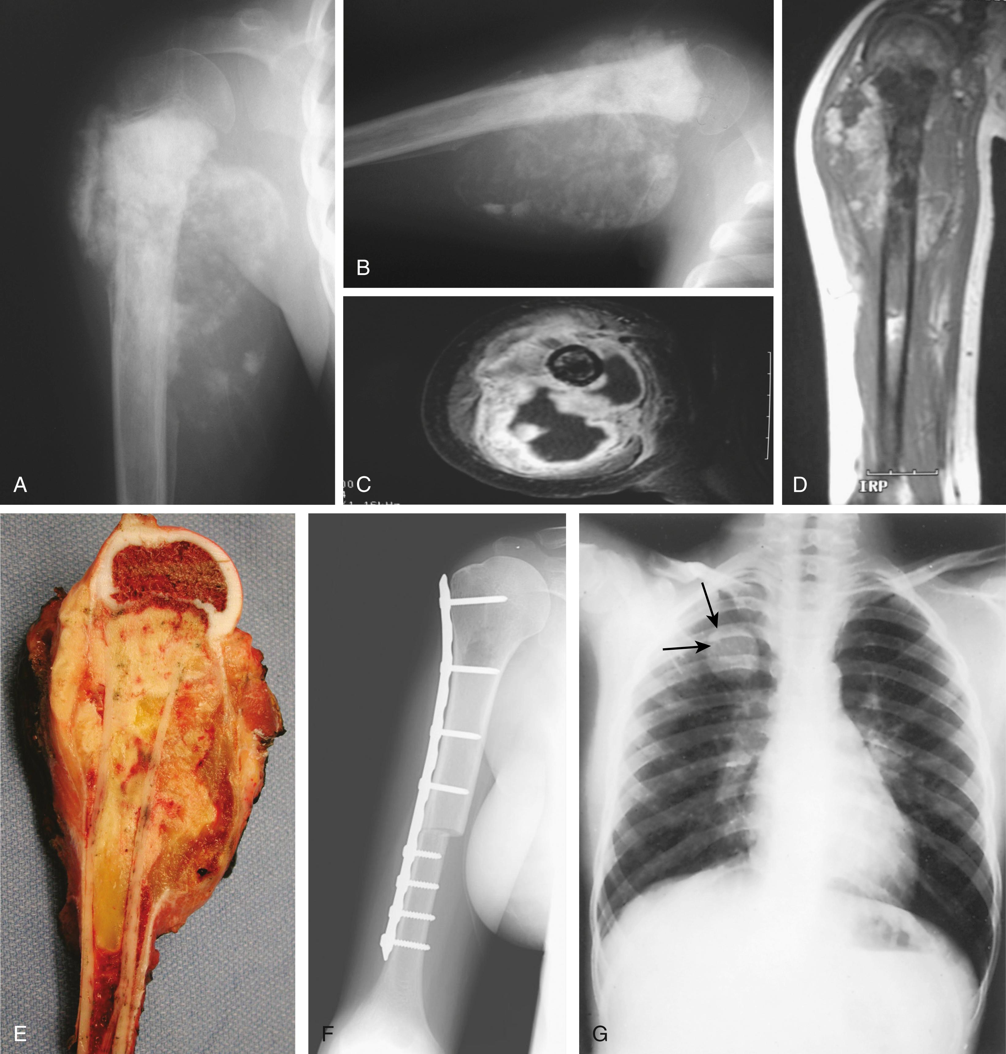 FIG. 26.5, Osteosarcoma of the right proximal humerus in an 8-year-old boy. The patient presented with pain and a mass in his arm. (A and B) Radiographs demonstrate a large mass in the metaphysis abutting the physis. Periosteal elevation and the corresponding Codman’s triangle are seen along the diaphysis. (C and D) MRI allows more precise identification of the local extent of the tumor. Areas of necrosis are seen on the axial section. The extent of the tumor in the medullary cavity can be appreciated on the coronal section. (E) Resection specimen, demonstrating scattered areas of neoplastic bone. (F) Example of proximal humeral allograft reconstruction in a different patient. (G) Example of a lung metastasis (arrows) . MRI , Magnetic resonance imaging.