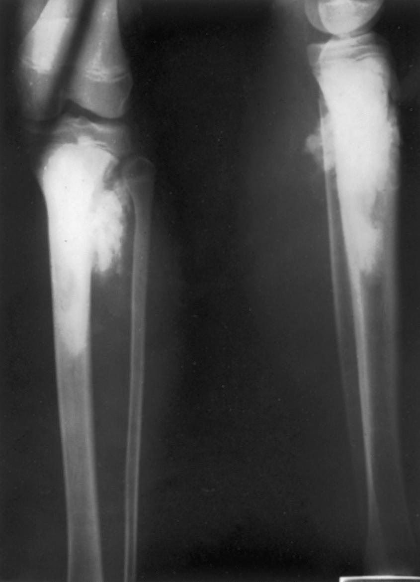 FIG. 26.6, Initial radiograph showing osteosarcoma of the proximal tibia.