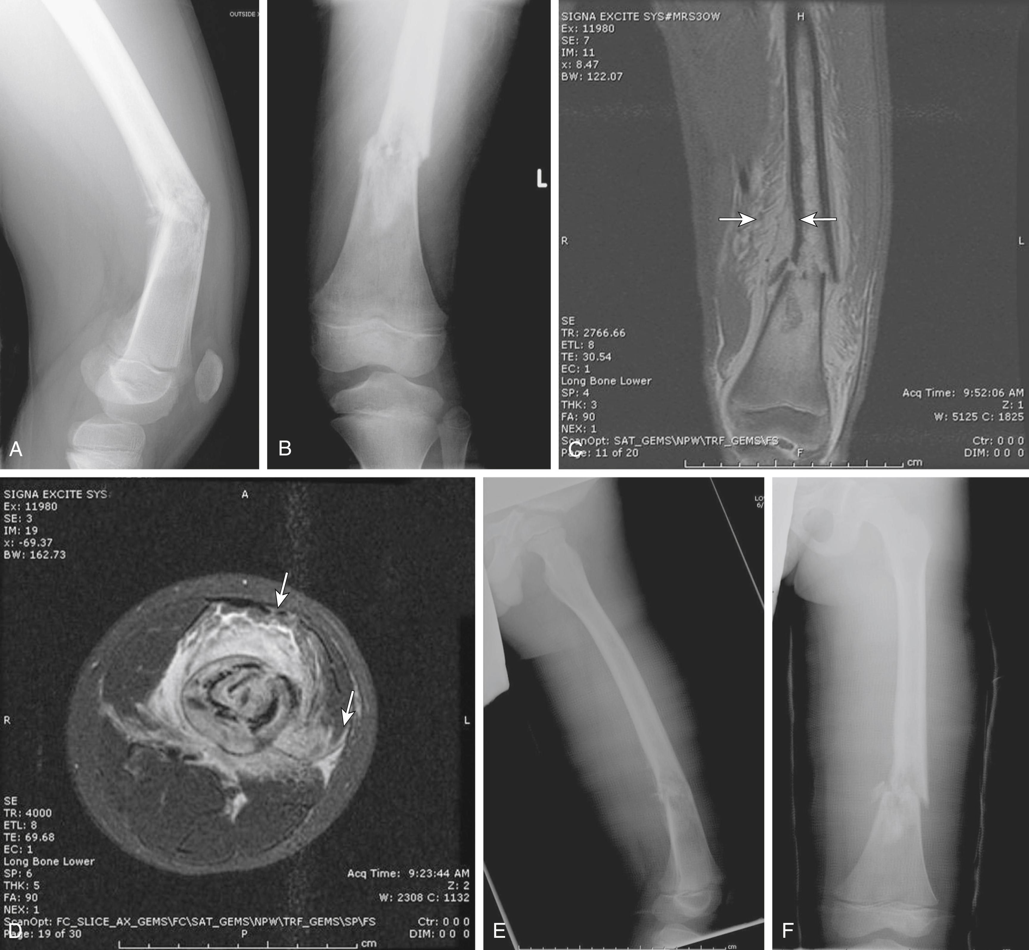 FIG. 26.7, Pathologic fracture as the presentation of osteosarcoma of the distal femur. (A and B) Radiographs demonstrate a displaced fracture of the distal femur. The medullary cavity immediately distal to the fracture demonstrates mixed radiolucent and radiodense areas. Note the periosteal elevation best seen on the lateral radiograph immediately proximal to the fracture, which is also suggestive of a pathologic fracture. (C and D) MRI scans demonstrate the tumor mass extending into the soft tissues. Note the extensive edema associated with the fracture (arrows) . (E and F) At the time of needle biopsy, the fracture was reduced, and the patient was placed in a cast for stabilization of the fracture while the chemotherapy regimen was begun. MRI , Magnetic resonance imaging.