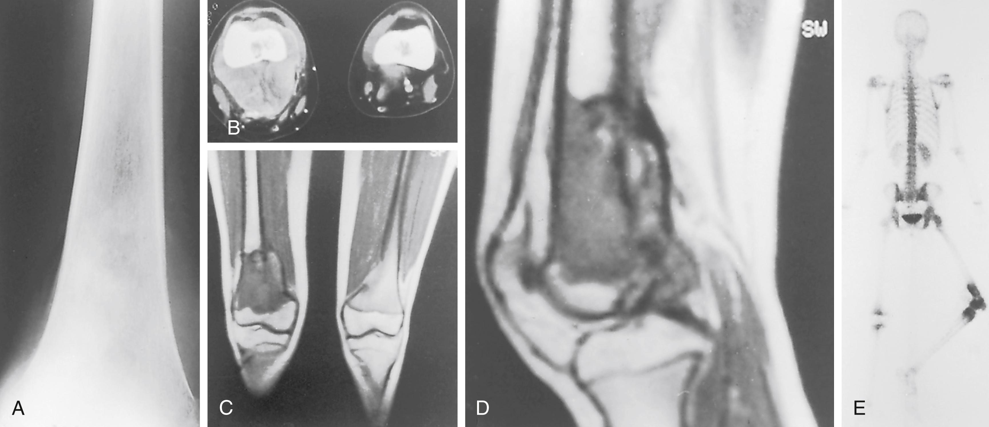 FIG. 26.8, Osteosarcoma of the left distal femur. (A) Plain anteroposterior radiograph. Note the distal metaphyseal and lower diaphyseal sclerotic lesion. (B) CT scan showing bone-forming tumor. (C and D) MRI scans showing the extent of the tumor and its relationship to the popliteal soft tissue. (E) Bone scan with technetium-99m showing increased uptake in the distal femoral metaphyseal region. CT , Computed tomography; MRI , magnetic resonance imaging.