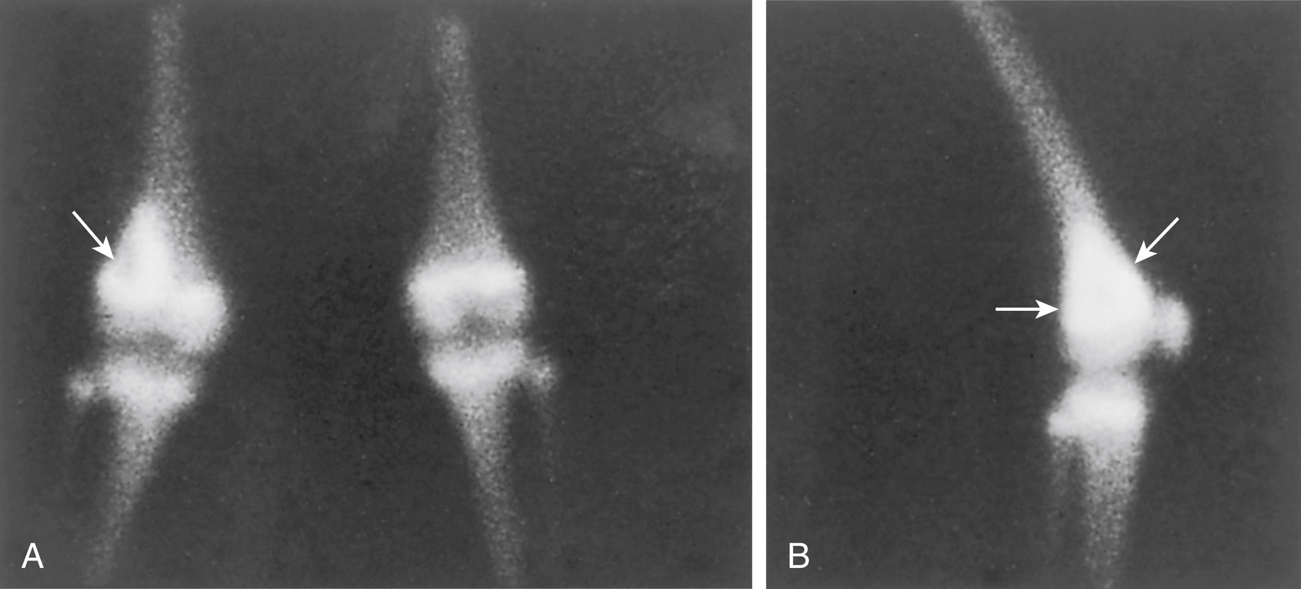 FIG. 26.9, Osteosarcoma of the right distal femoral metaphysis. Shown are bone scan findings with technetium-99m. Note the increased uptake in the area of the lesion (arrows) in anterior-posterior (A) and lateral (B) projections.