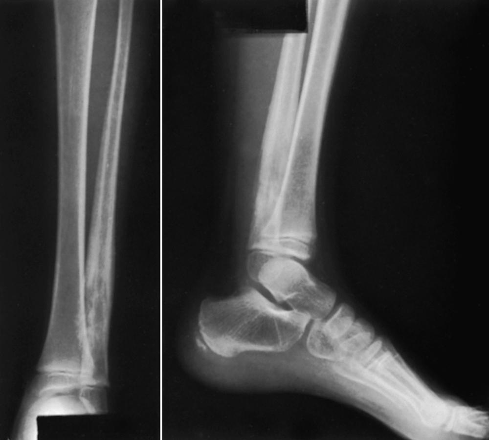 FIG. 26.10, Osteosarcoma of the distal left fibula in a 5-year-old girl. Initial radiographs of the left leg showed a destructive lesion of the distal metaphysis of the fibula with periosteal new bone formation and soft tissue swelling. Chest CT and bone scan showed no other lesions. Histologic examination of a biopsy specimen disclosed the tumor to be osteosarcoma. Because of the location of the tumor and the age of the patient, she was treated with a below-knee amputation and adjuvant chemotherapy. CT , Computed tomography.