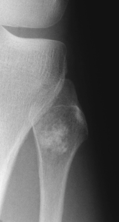 Chondrosarcoma. AP XR showing a mineralized lesion of the fibula due to low-grade chondrosarcoma. The lesion cannot be radiologically differentiated from a chondroma. *