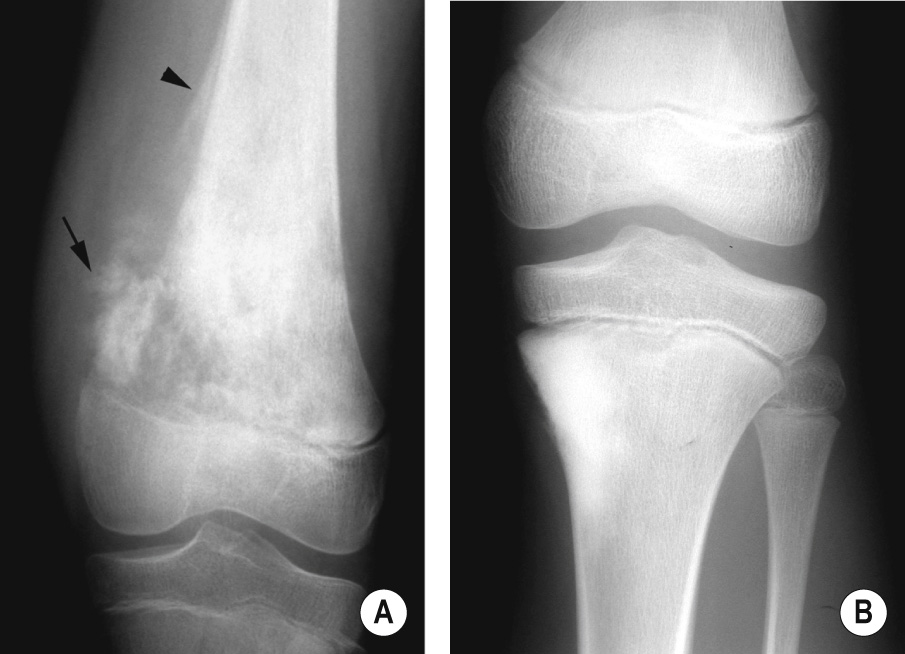 Conventional central osteosarcoma. (A) AP XR of the distal femur showing a classical osteosarcoma with mixed lytic and sclerotic areas, tumour bone formation in the extraosseous mass (arrow), and a proximal Codman's triangle (arrowhead). (B) AP XR of the proximal tibia showing dense metaphyseal sclerosis due to an osteoblastic osteosarcoma. *