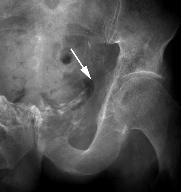 Radiation-induced sarcoma of the left superior pubic ramus manifest as a region of lytic bone destruction (arrow) with underlying radiation osteitis. *