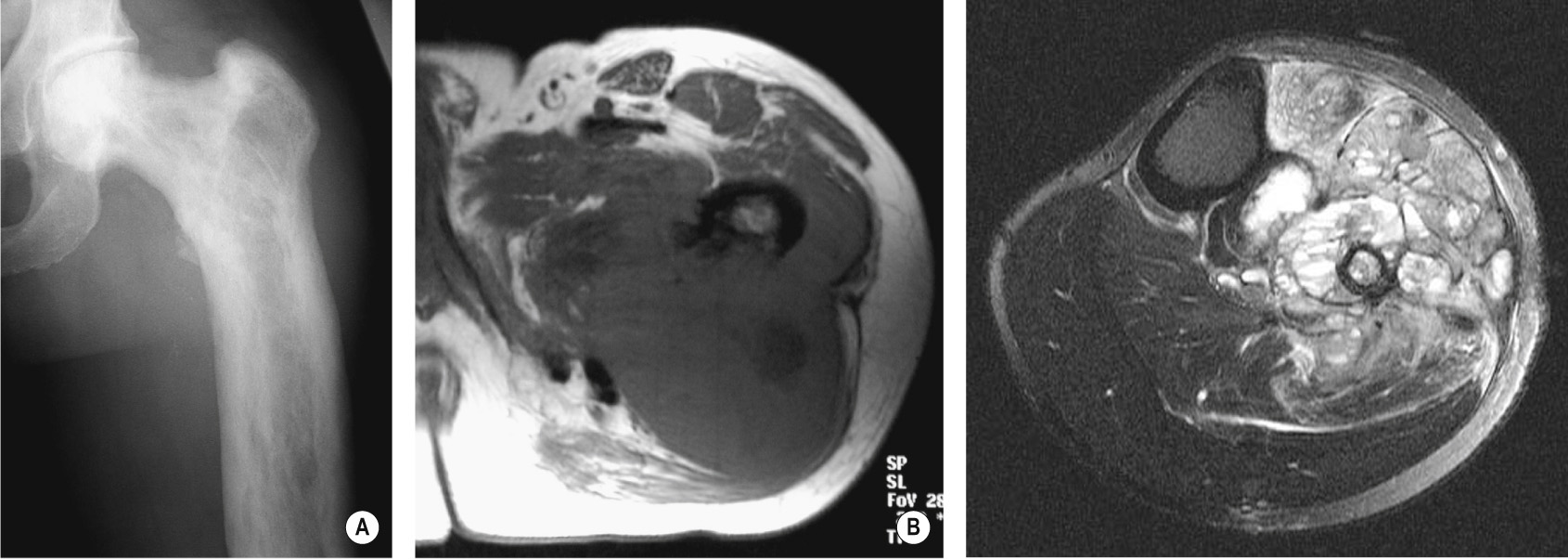 Paget's sarcoma. (A) AP XR of the proximal femur showing Paget's disease. (B) Axial T1WI shows an associated large soft tissue mass due to sarcomatous change. *