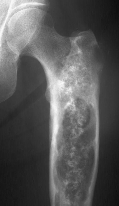 AP radiograph of the femur showing an extensive central chondrosarcoma with typical chondroid matrix, cortical expansion and thickening with endosteal scalloping. **