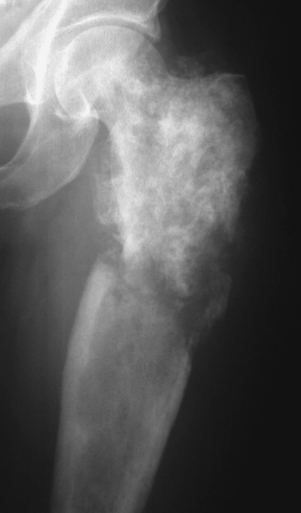 Dedifferentiated chondrosarcoma. AP XR showing a proximal femoral chondrosarcoma with an adjacent area of lytic destruction and a pathological fracture. *