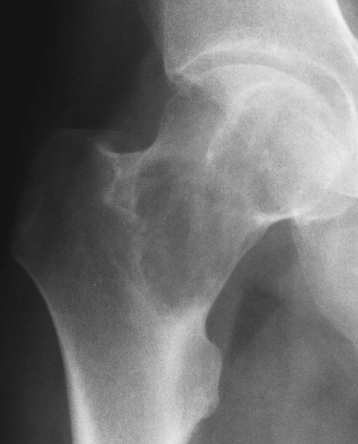 AP radiograph of the hip showing a clear-cell chondrosarcoma as a well-defined lytic lesion extending up to the articular margin. **