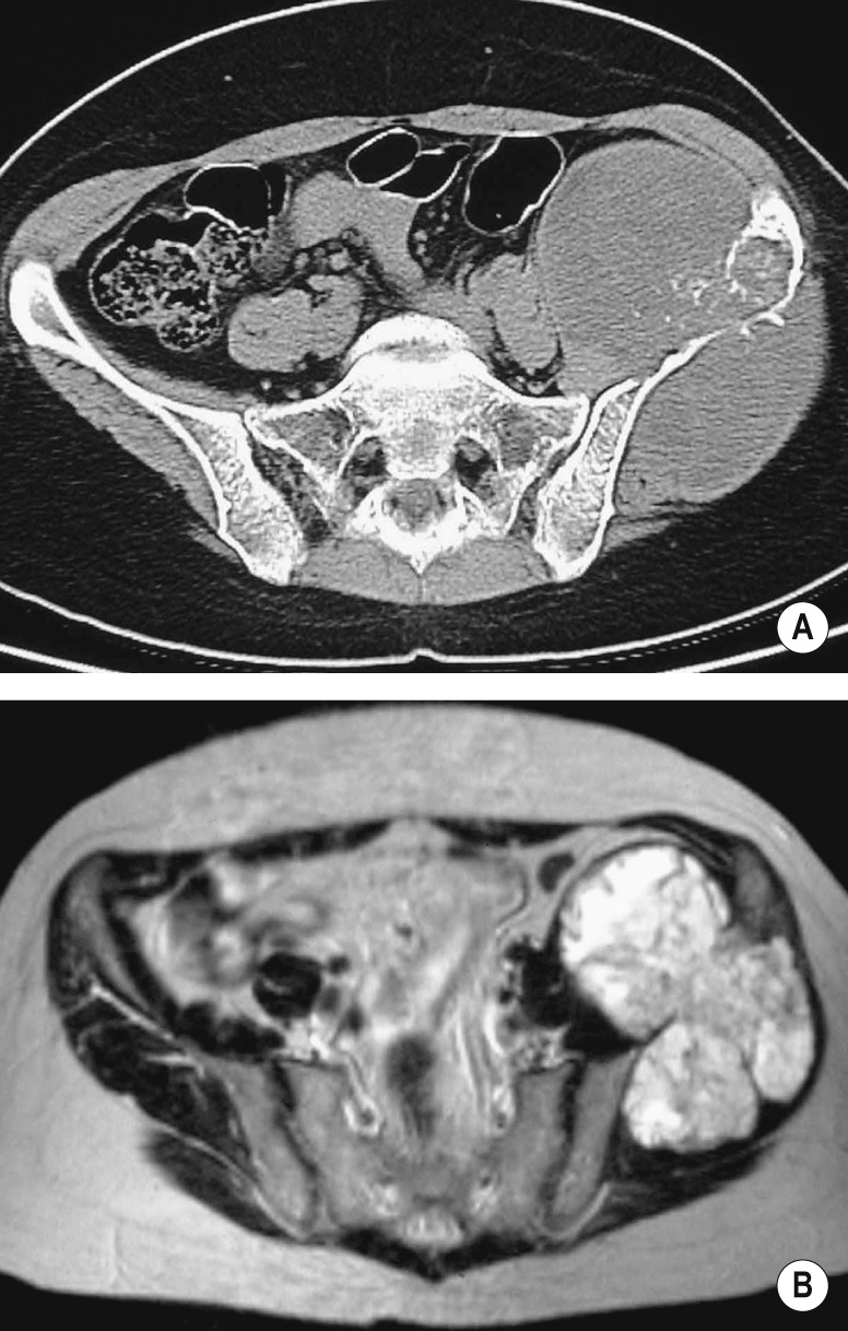 Chondrosarcoma of the left ilium. Axial CT (A) and T2WI (B) show a large extraosseous mass. *
